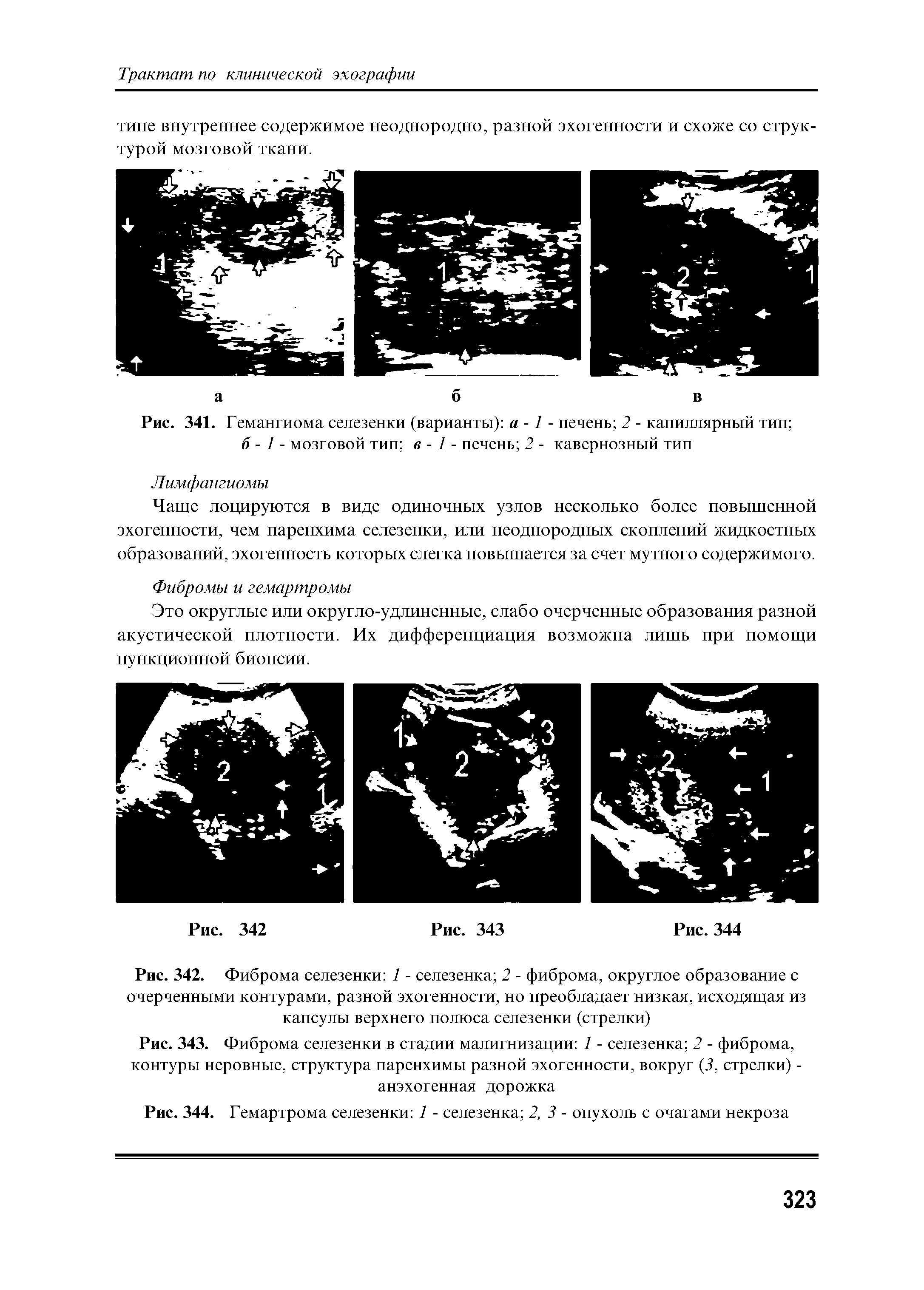 Рис. 341. Гемангиома селезенки (варианты) а -1 - печень 2 - капиллярный тип б - 1 - мозговой тип в - 1 - печень 2 - кавернозный тип...