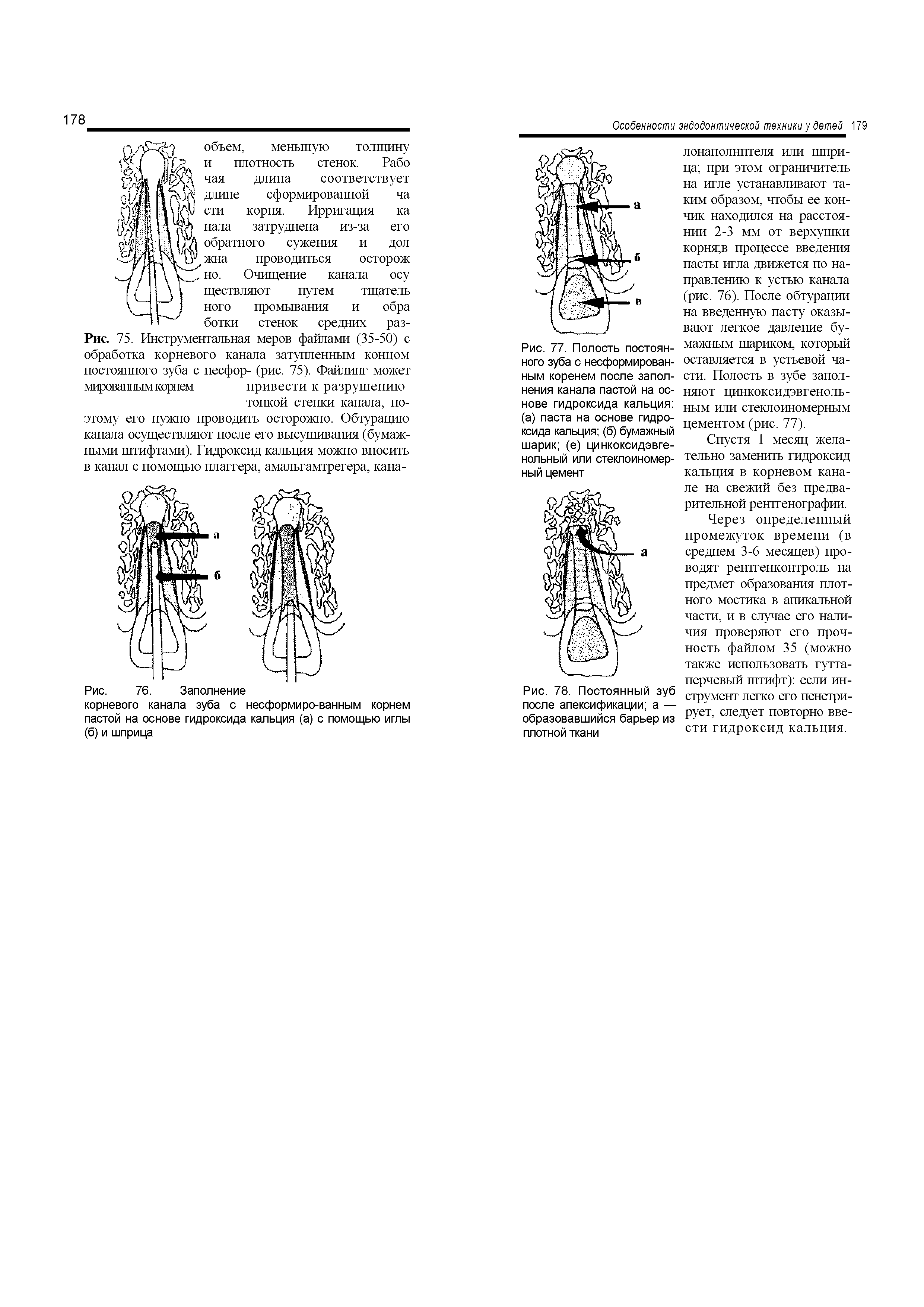 Рис. 75. Инструментальная меров файлами (35-50) с обработка корневого канала затупленным концом постоянного зуба с несфор- (рис. 75). Файлинг может мированным корнем привести к разрушению...