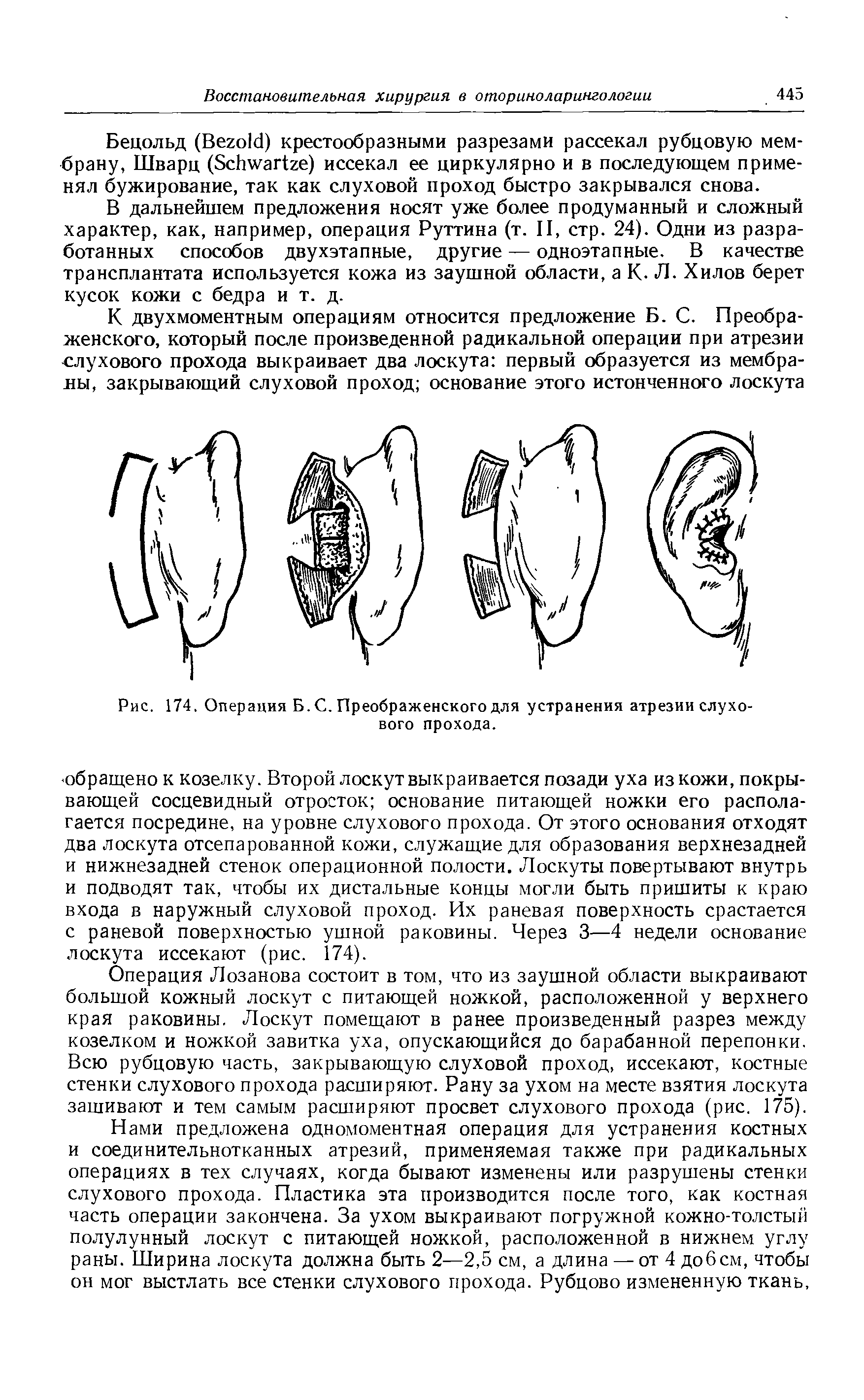Рис. 174. Операция Б. С. Преображенского для устранения атрезии слухового прохода.