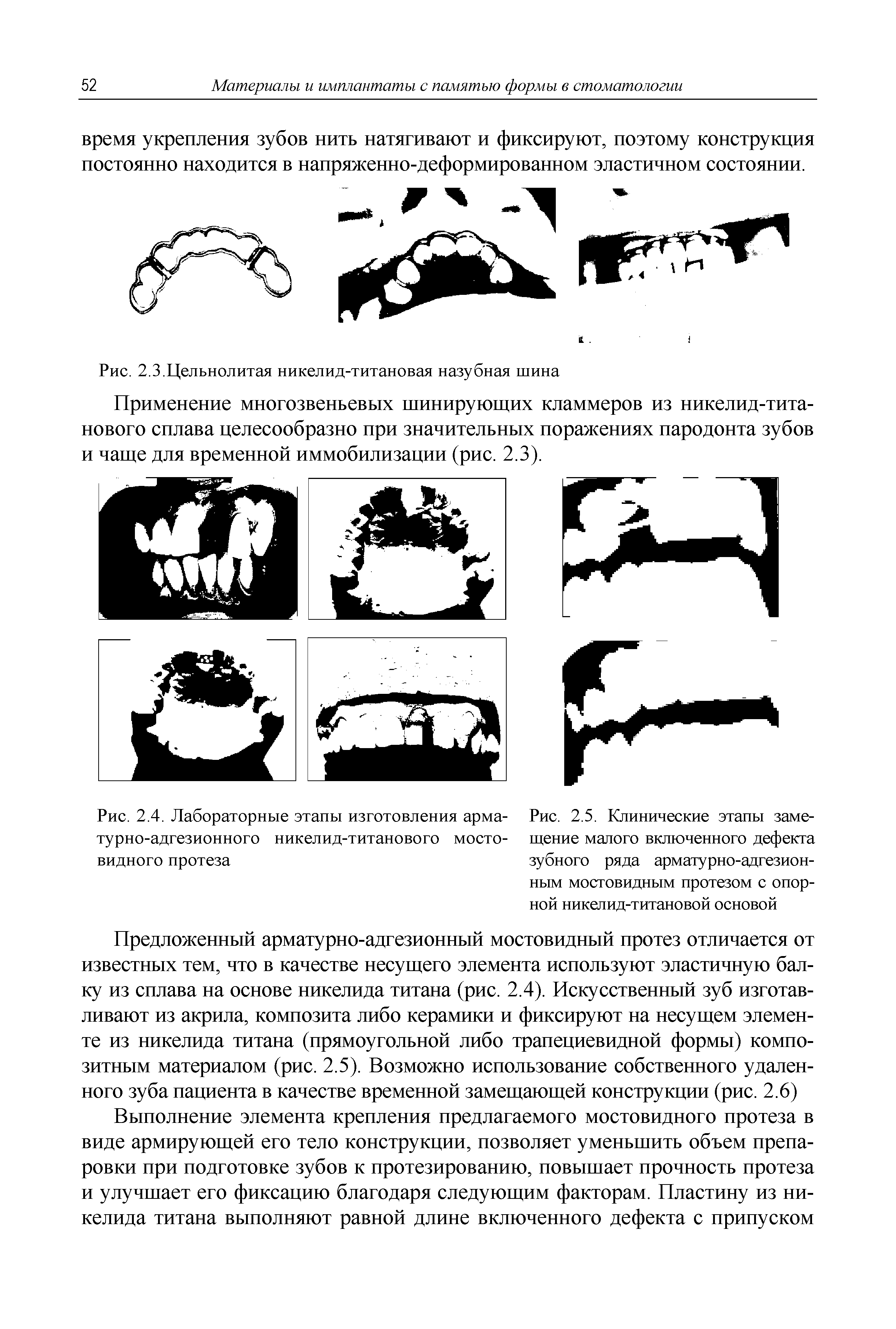 Рис. 2.5. Клинические этапы замещение малого включенного дефекта зубного ряда арматурно-адгезионным мостовидным протезом с опорной никелид-титановой основой...