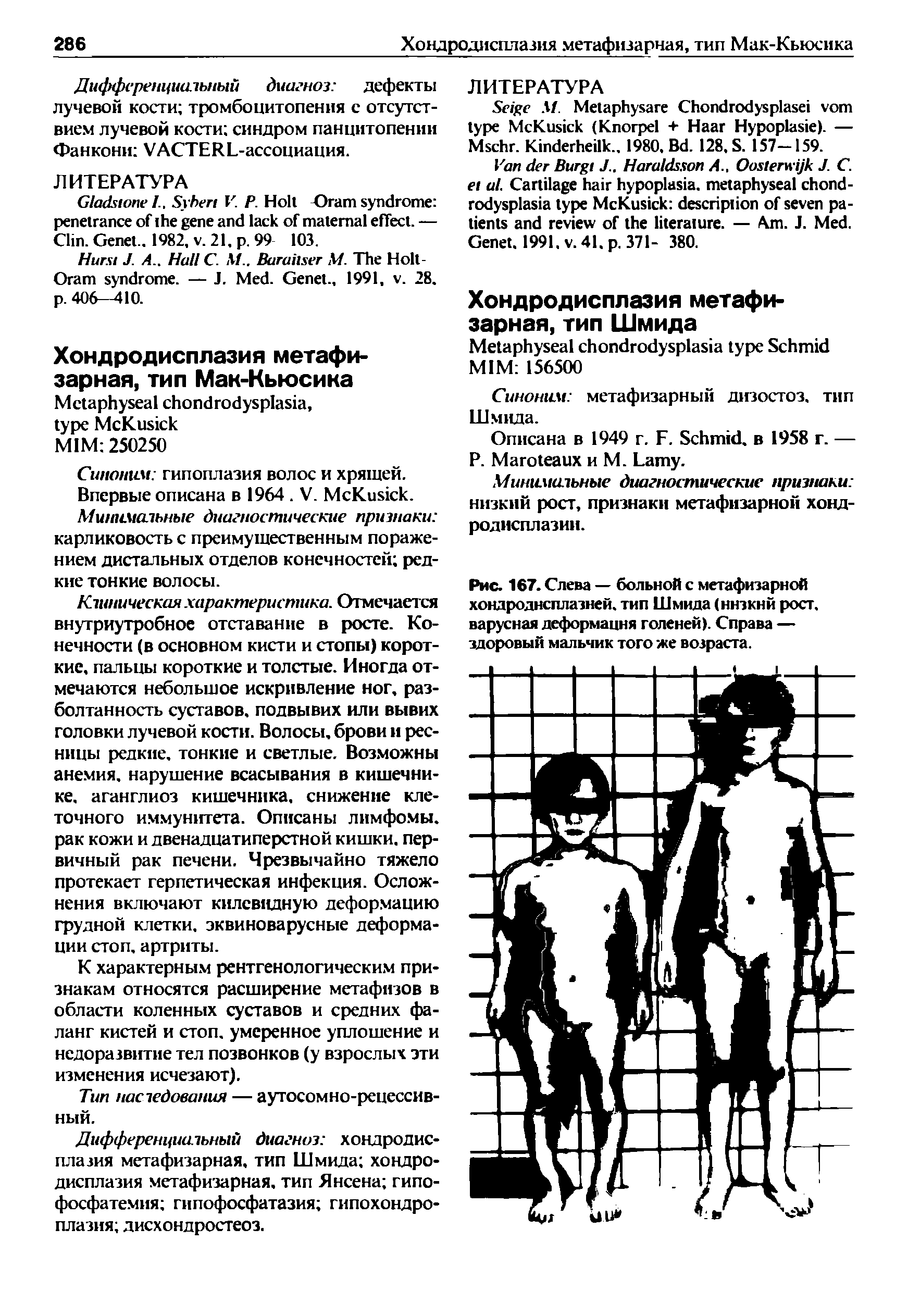 Рис. 167. Слева — больной с метафизарной хондродисплазией, тип Шмида (низкий рост, варусная деформация голеней). Справа — здоровый мальчик того же возраста.