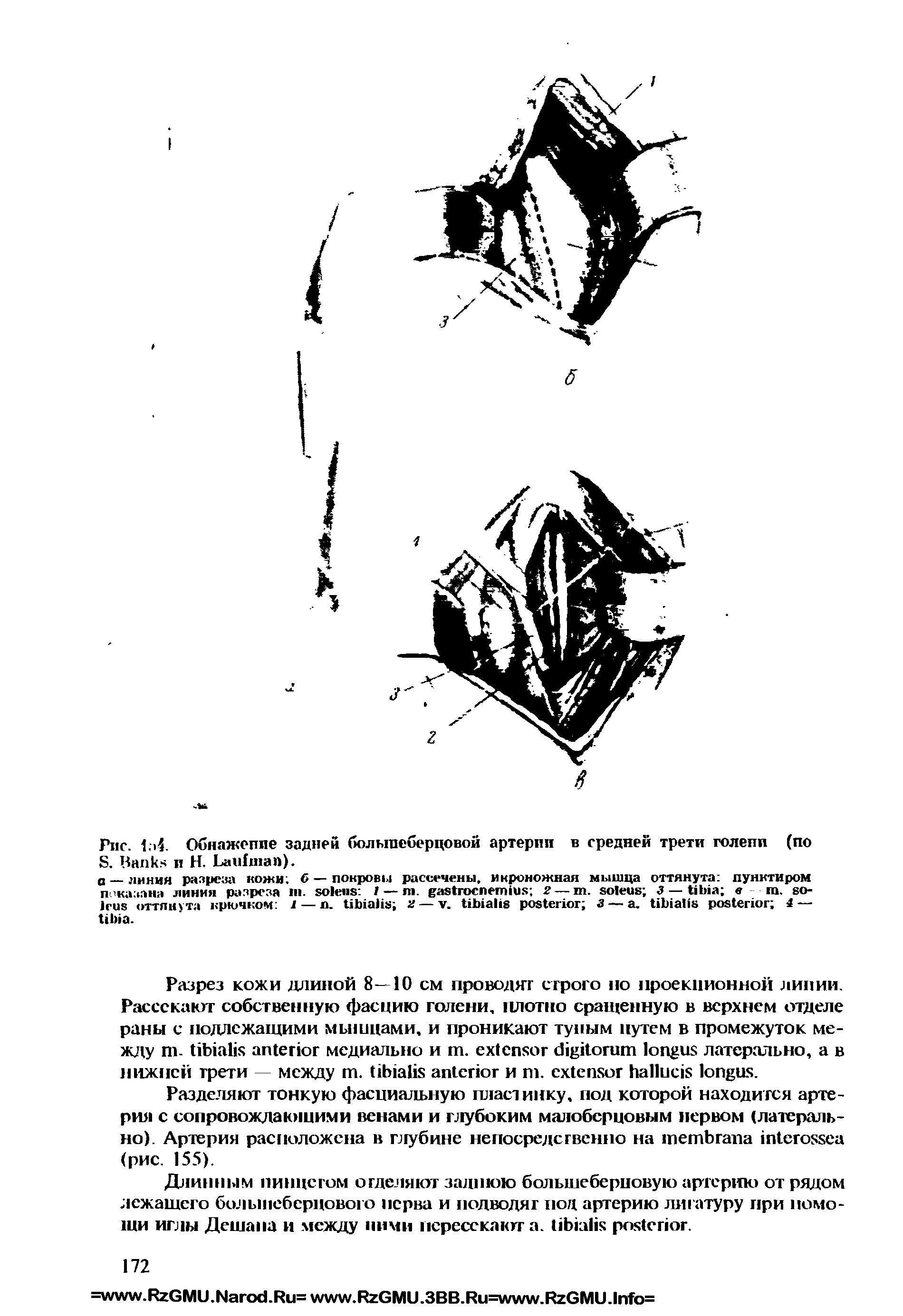 Рис. 1 4. Обнажение задней большеберцовой артерии в средней трети голепп (по S. B и Н. L ).