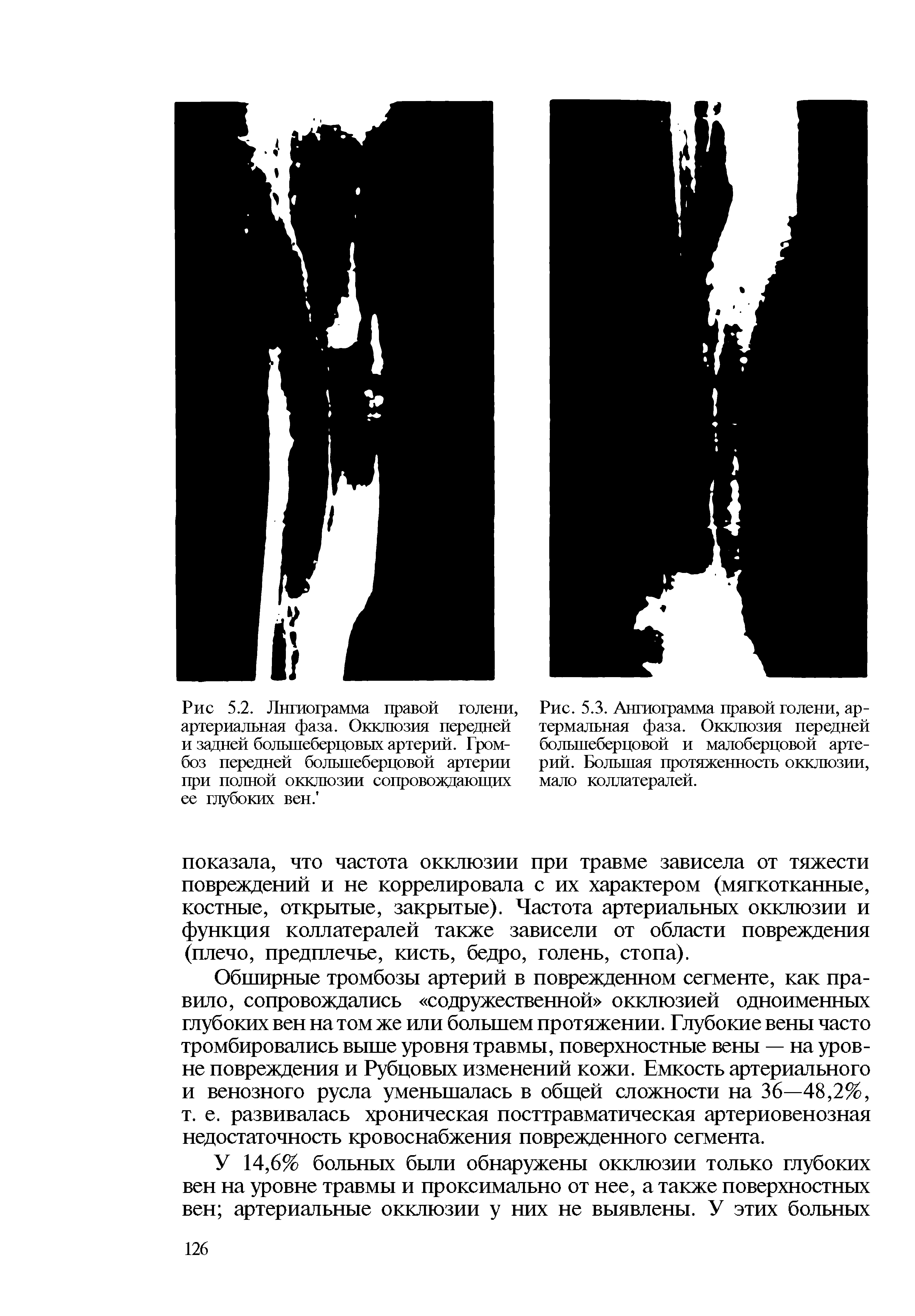 Рис. 5.3. Ангиограмма правой голени, ар-термальная фаза. Окклюзия передней большеберцовой и малоберцовой артерий. Большая протяженность окклюзии, мало коллатералей.