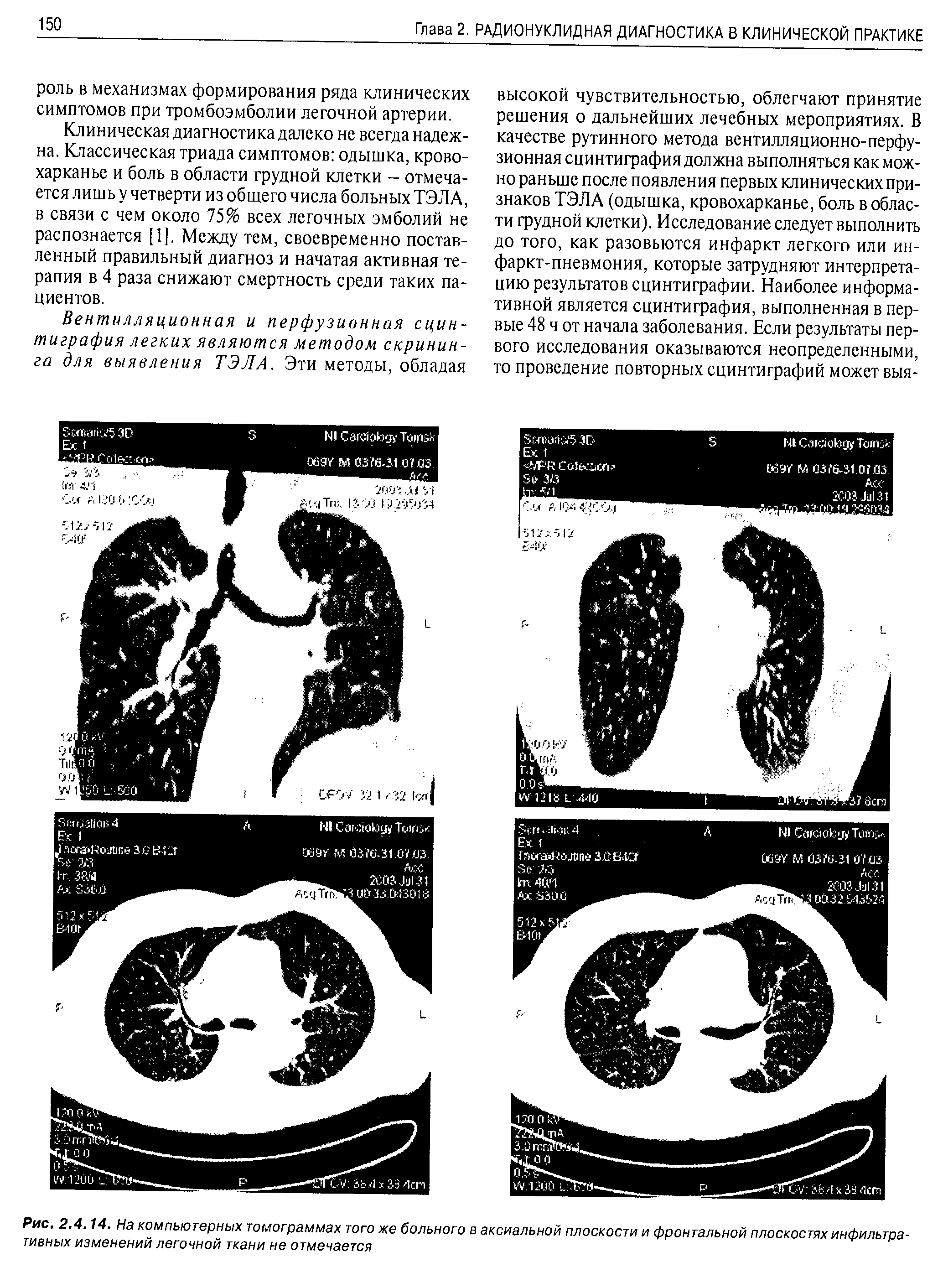 Рис. 2.4.14. На компьютерных томограммах того же больного в аксиальной плоскости и фронтальной плоскостях инфильтративных изменений легочной ткани не отмечается...