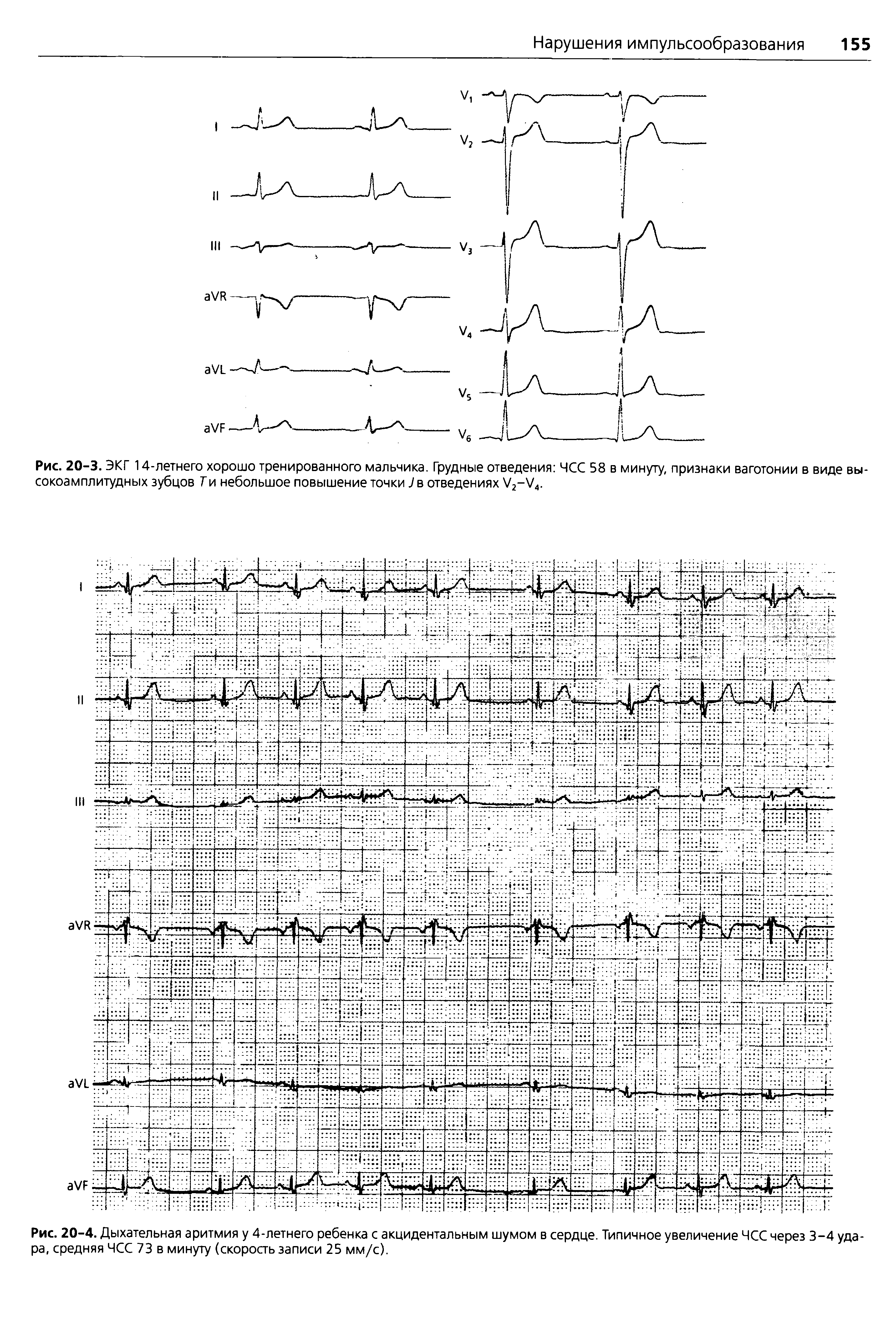 Рис. 20-4. Дыхательная аритмия у 4-летнего ребенка с акцидентальным шумом в сердце. Типичное увеличение ЧСС через 3-4 удара, средняя ЧСС 73 в минуту (скорость записи 25 мм/с).