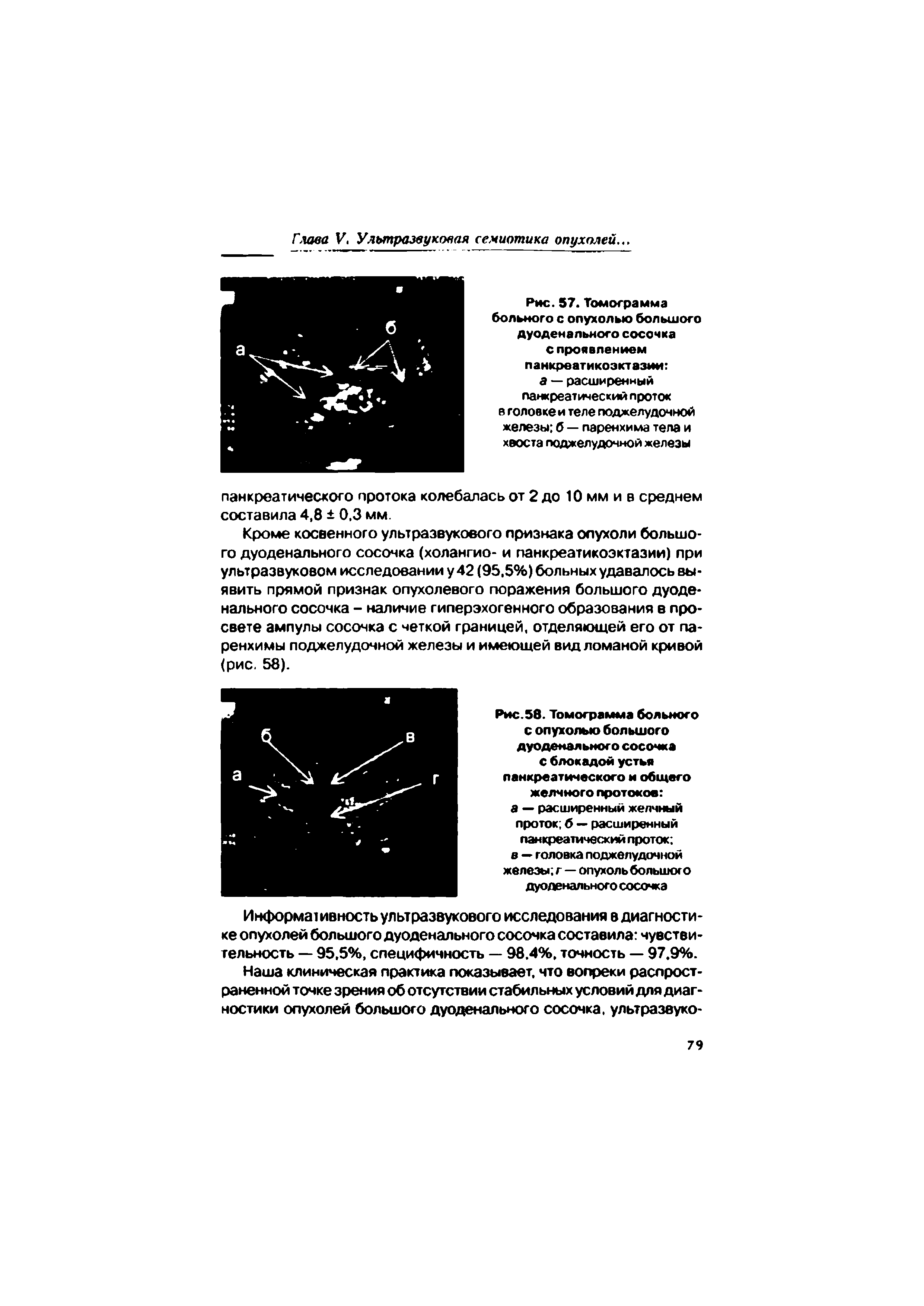 Рис. 57. Томограмма больного с опухолью большого дуоденального сосочка С проявлением панкреатикоэктазии а — расширенный панкреатический проток в головке и теле поджелудочной железы б — паренхима тела и хвоста поджелудочной железы...