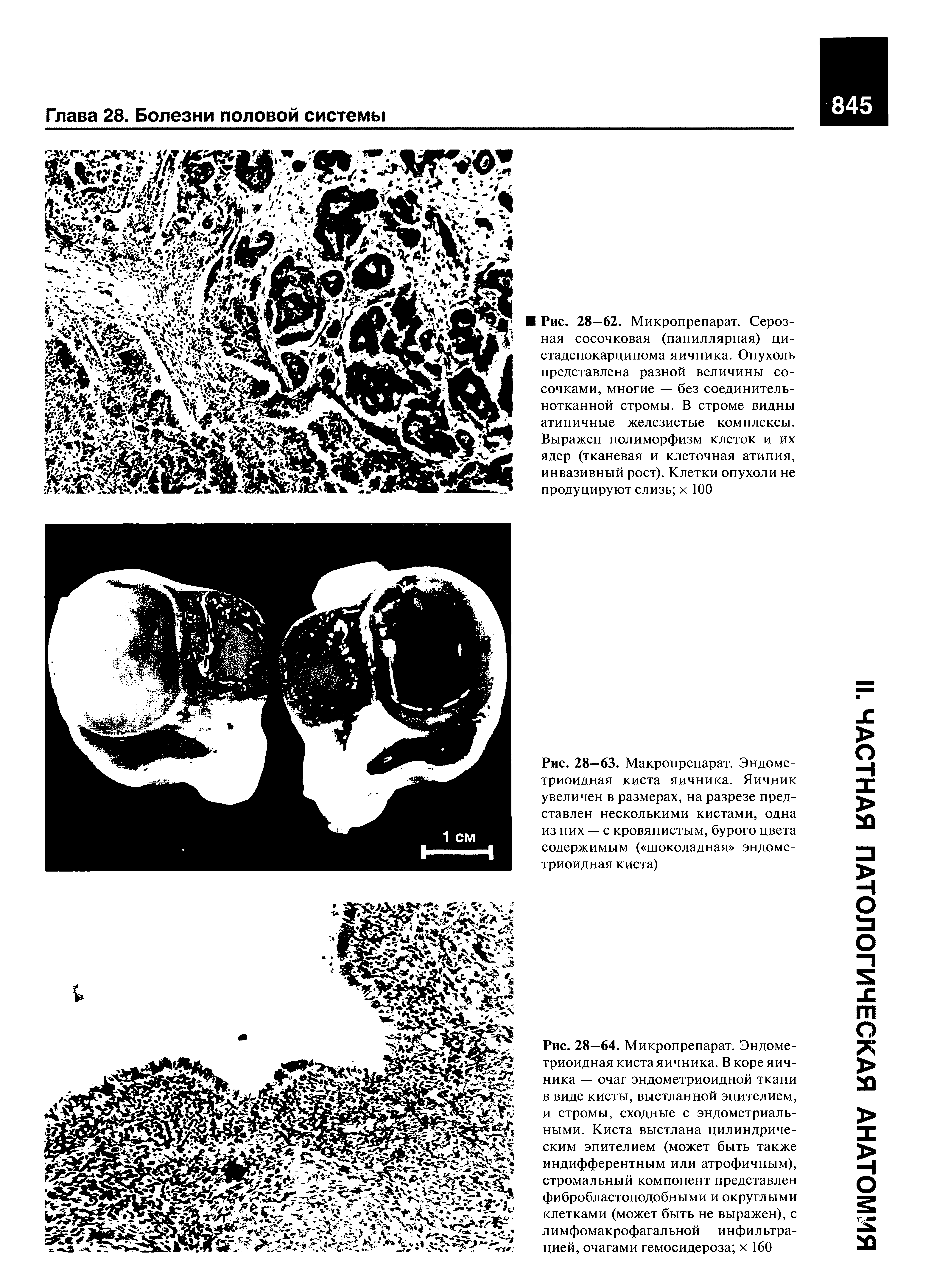 Рис. 28—63. Макропрепарат. Эндометриоидная киста яичника. Яичник увеличен в размерах, на разрезе представлен несколькими кистами, одна из них — с кровянистым, бурого цвета содержимым ( шоколадная эндометриоидная киста)...