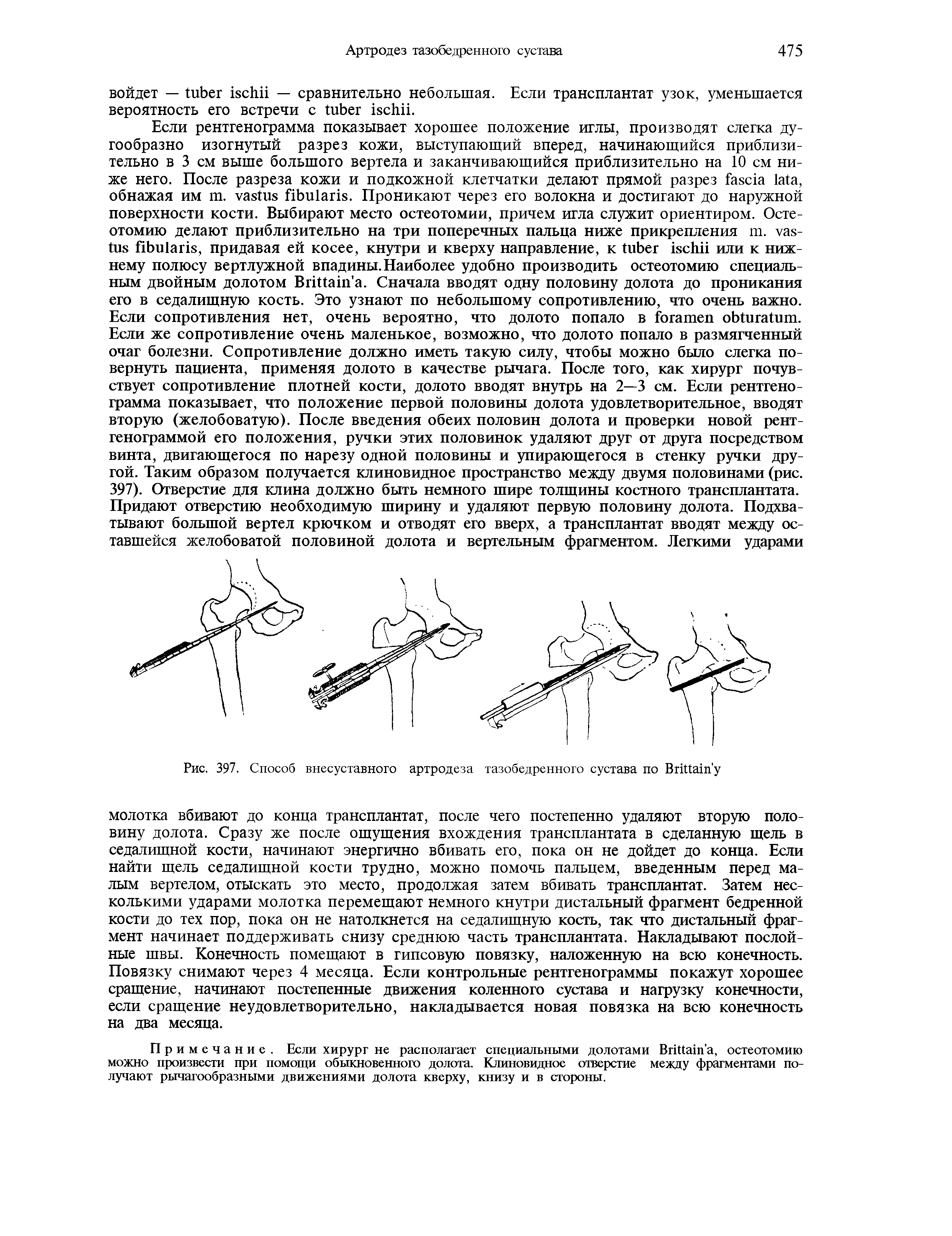 Рис. 397. Способ внесуставного артродеза тазобедренного сустава по Впйа1п у...