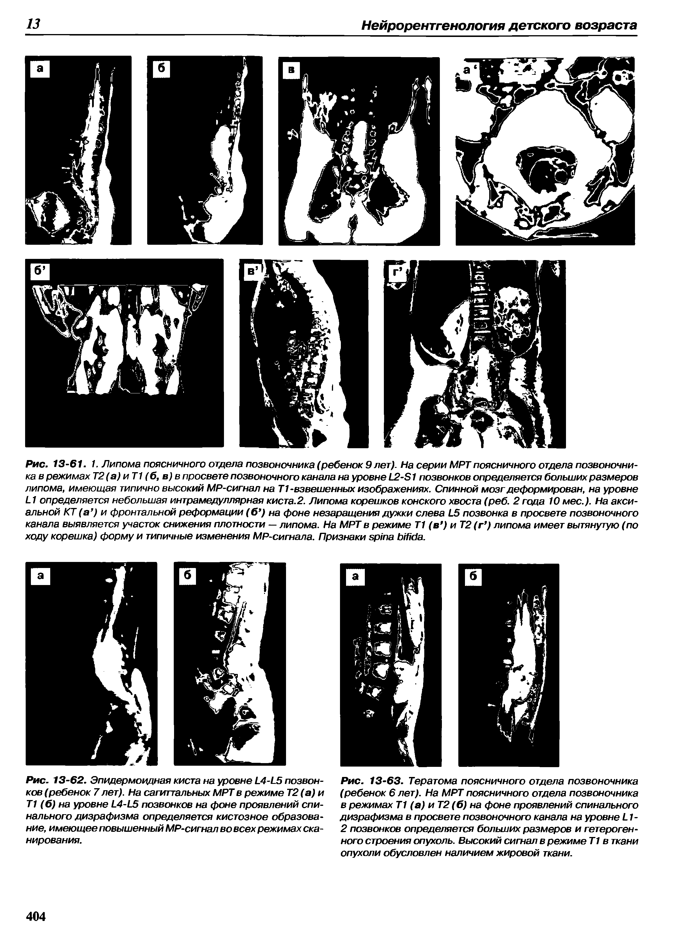 Рис. 13-62. Эпидермоидная киста на уровне L4-L5 позвонков (ребенок 7 лет). На сагиттальных МРТ в режиме Т2 (а) и Т1 (б) на уровне L4-L5 позвонков на фоне проявлений спинального дизрафизма определяется кистозное образование, имеющее повышенный MP-сигнал во всех режимах сканирования.