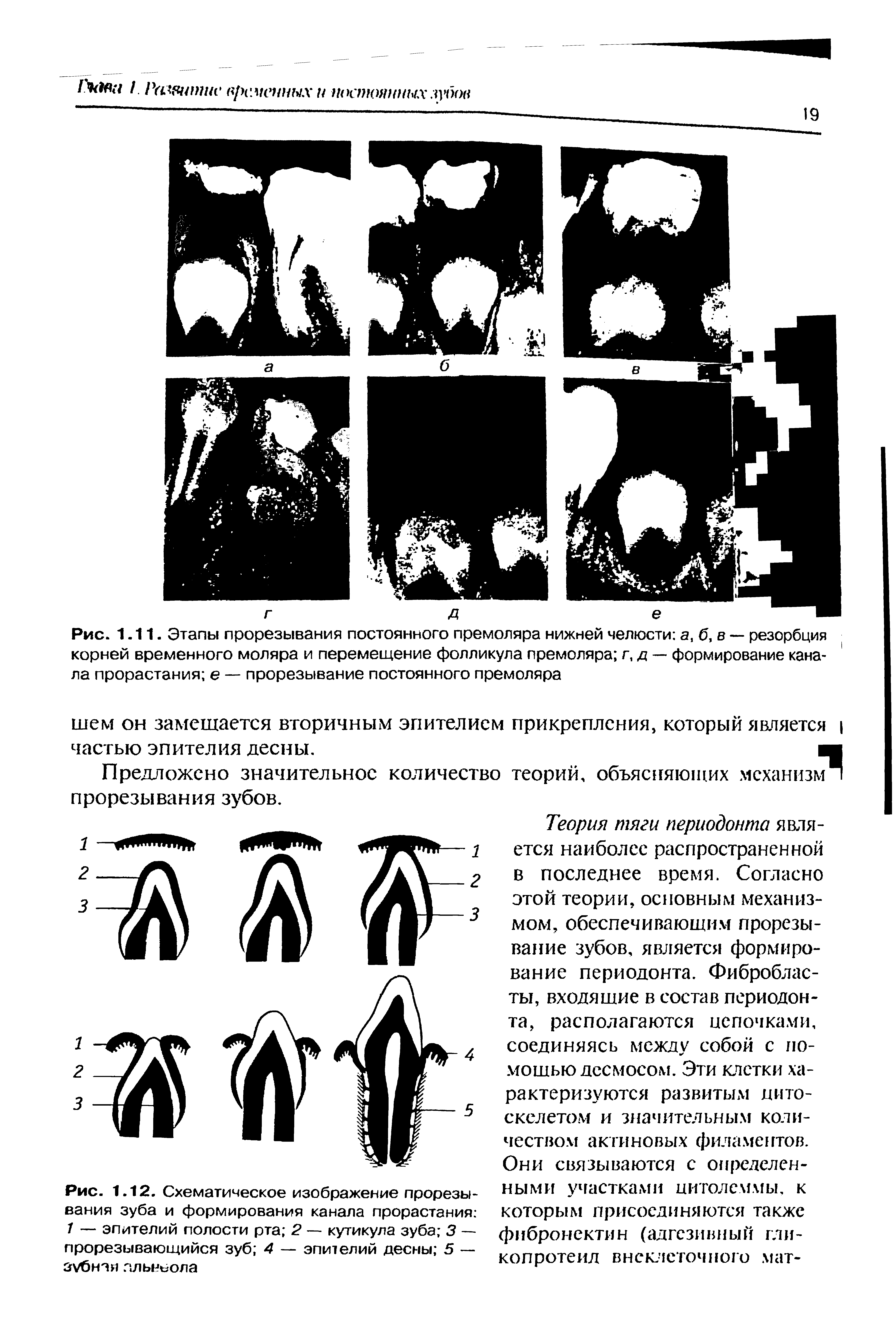 Рис. 1.12. Схематическое изображение прорезывания зуба и формирования канала прорастания 1 — эпителий полости рта 2 — кутикула зуба 3 — прорезывающийся зуб 4 — эпителий десны 5 — зубная альвеола...
