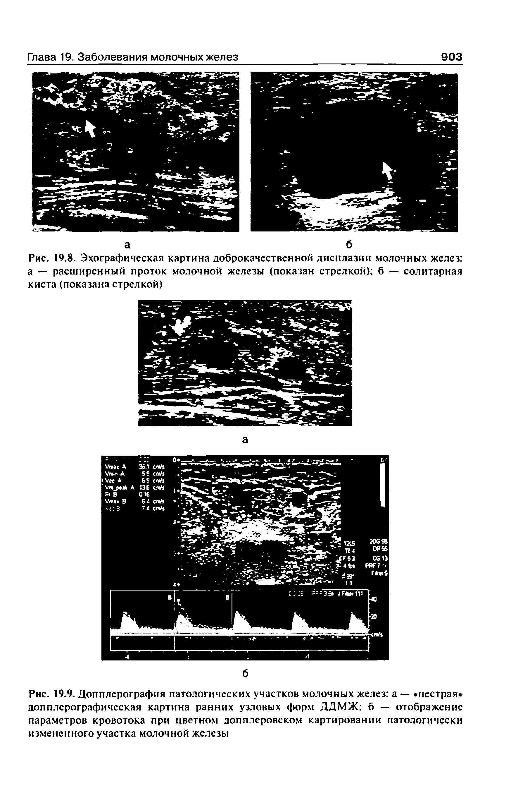 Рис. 19.8. Эхографическая картина доброкачественной дисплазии молочных желез а — расширенный проток молочной железы (показан стрелкой) б — солитарная киста (показана стрелкой)...