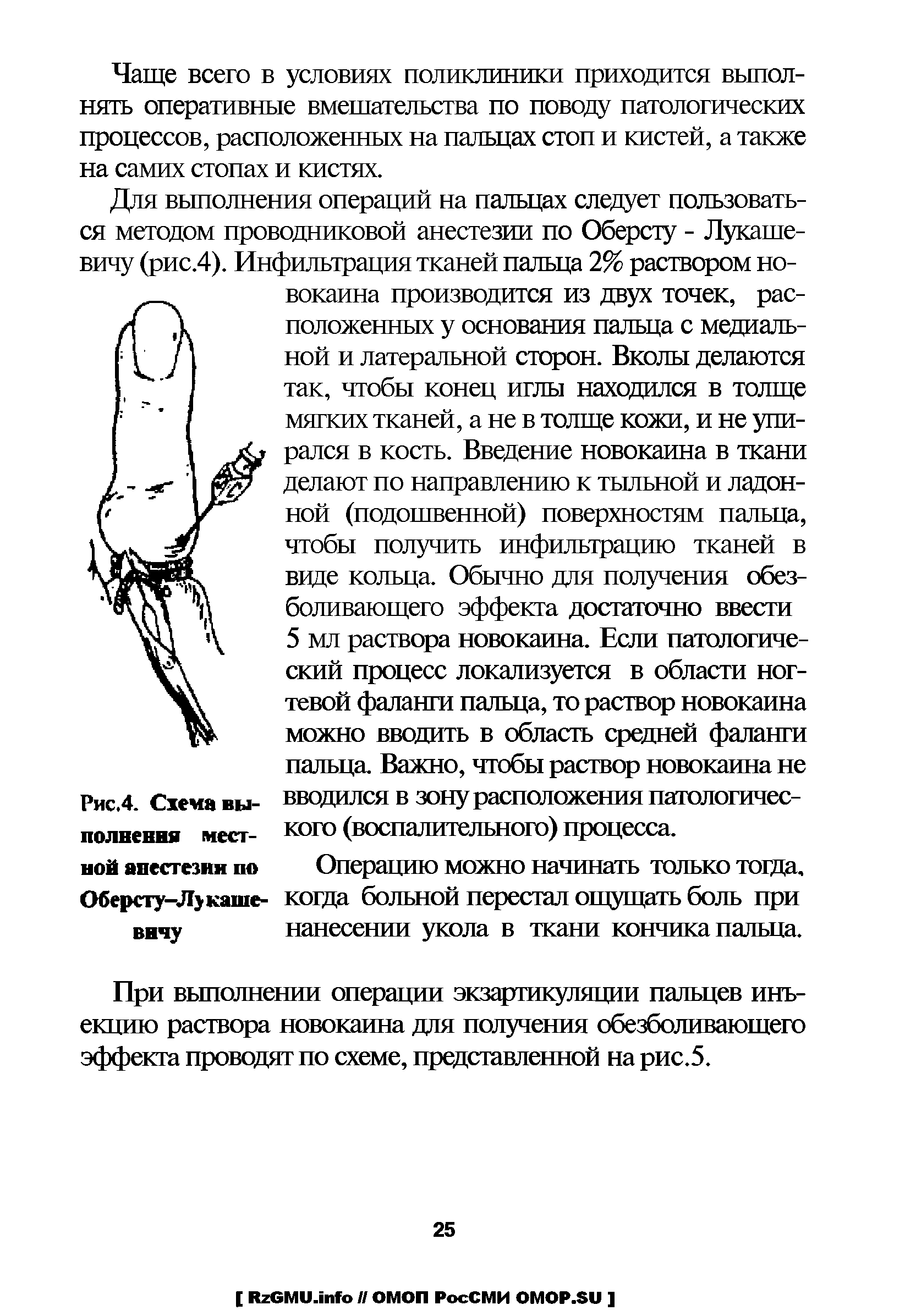 Рис.4. Схема выполнения местной анестезии по Оберсту-Лу каше-внчу...