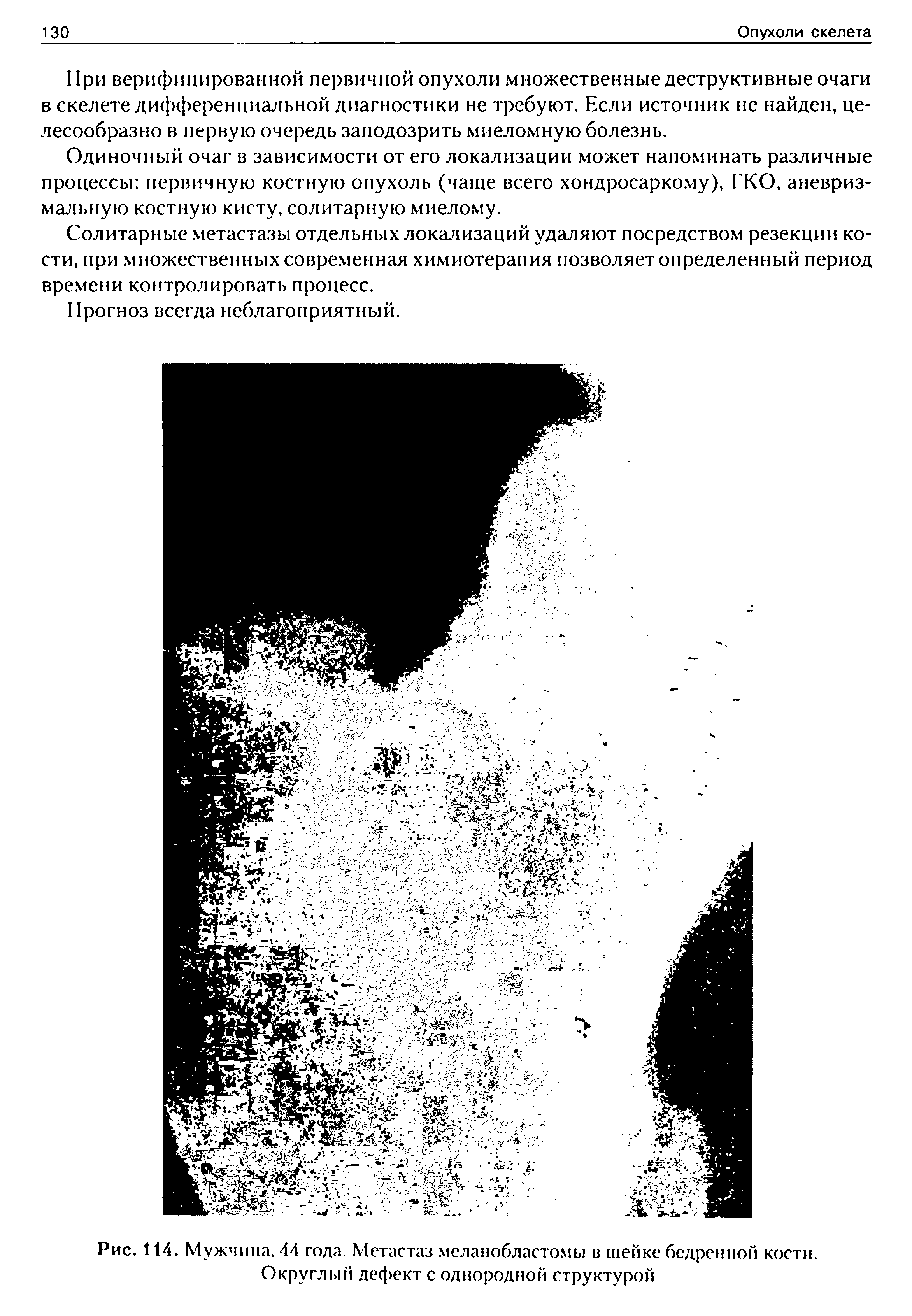 Рис. 114. Мужчина. 44 года. Метастаз меланобластомы в шейке бедренной кости. Округлый дефект с однородной структурой...