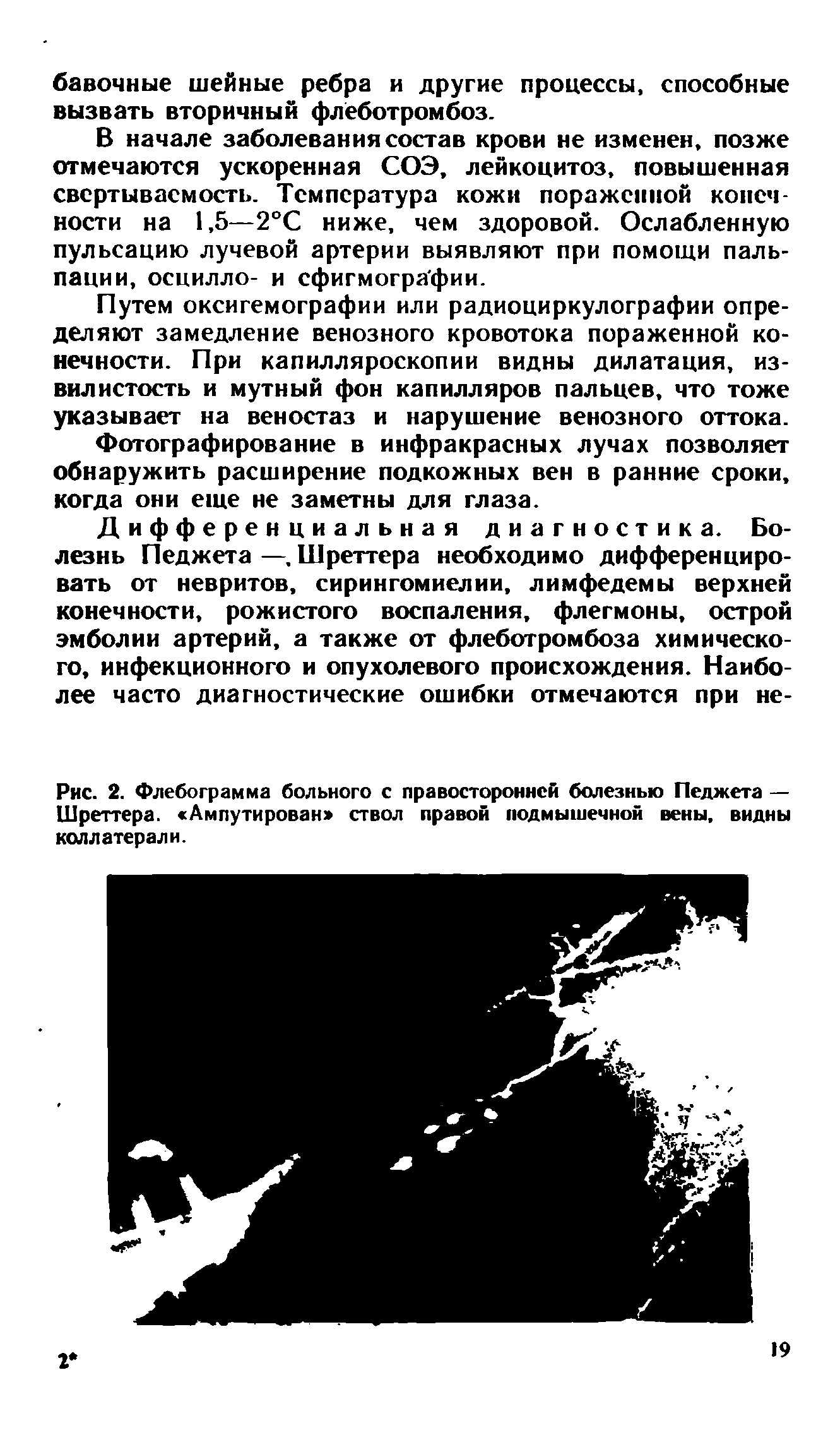 Рис. 2. Флебограмма больного с правосторонней болезнью Педжета — Шреттера. Ампутирован ствол правой подмышечной вены, видны коллатерали.