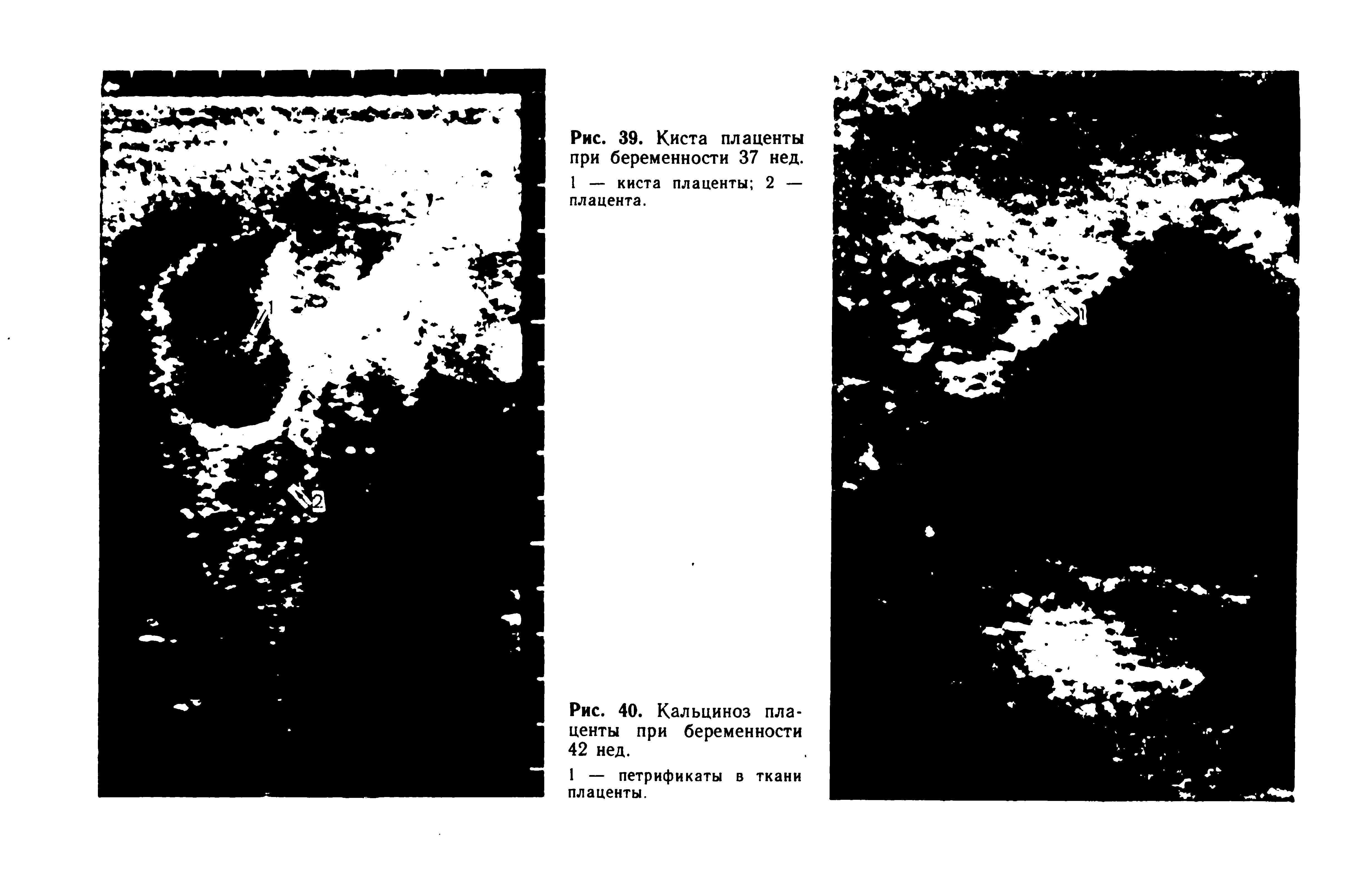 Рис. 39. Киста плаценты при беременности 37 нед. 1 — киста плаценты 2 — плацента.