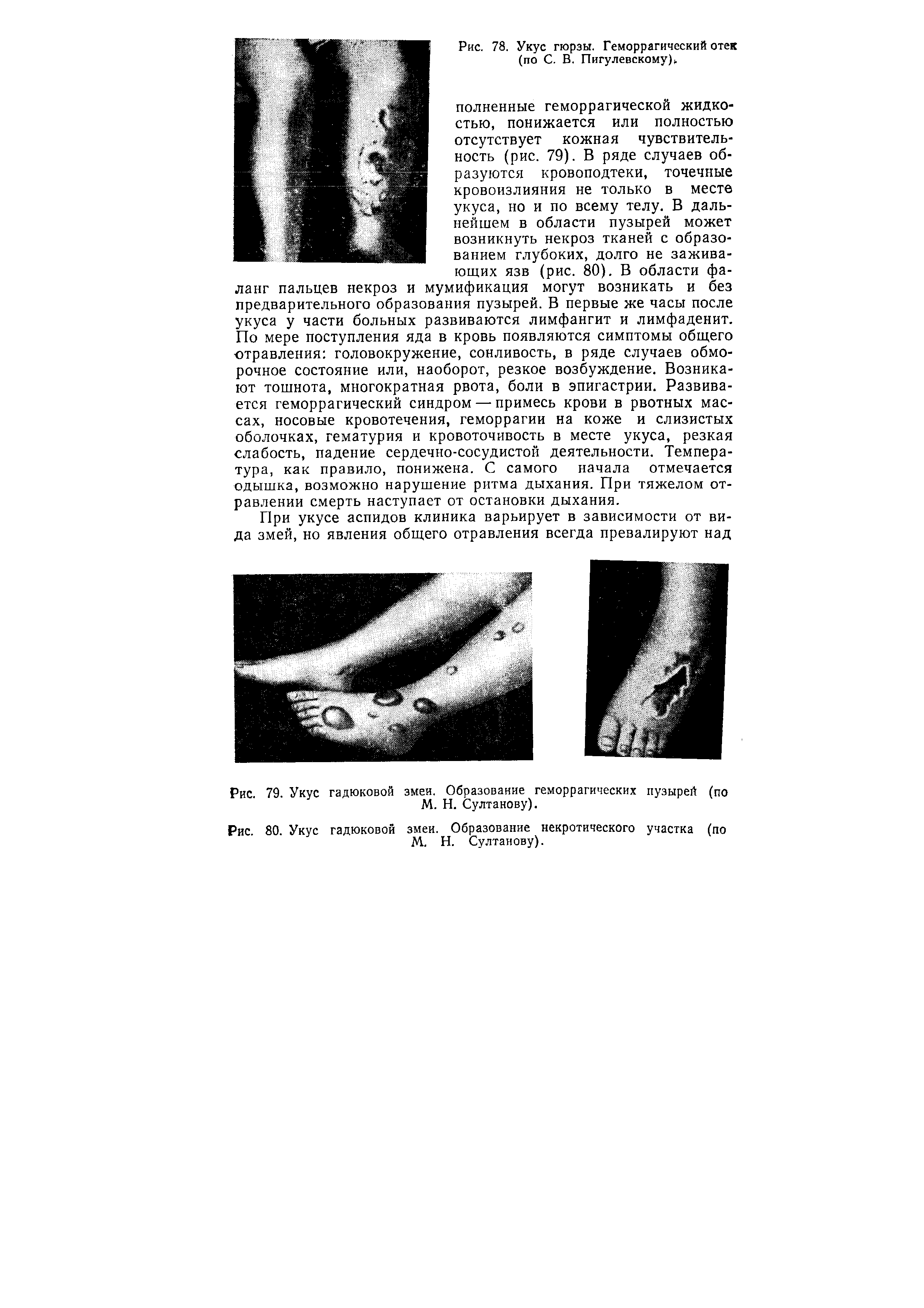 Рис. 80. Укус гадюковой змеи. Образование некротического участка (по М. Н. Султанову).