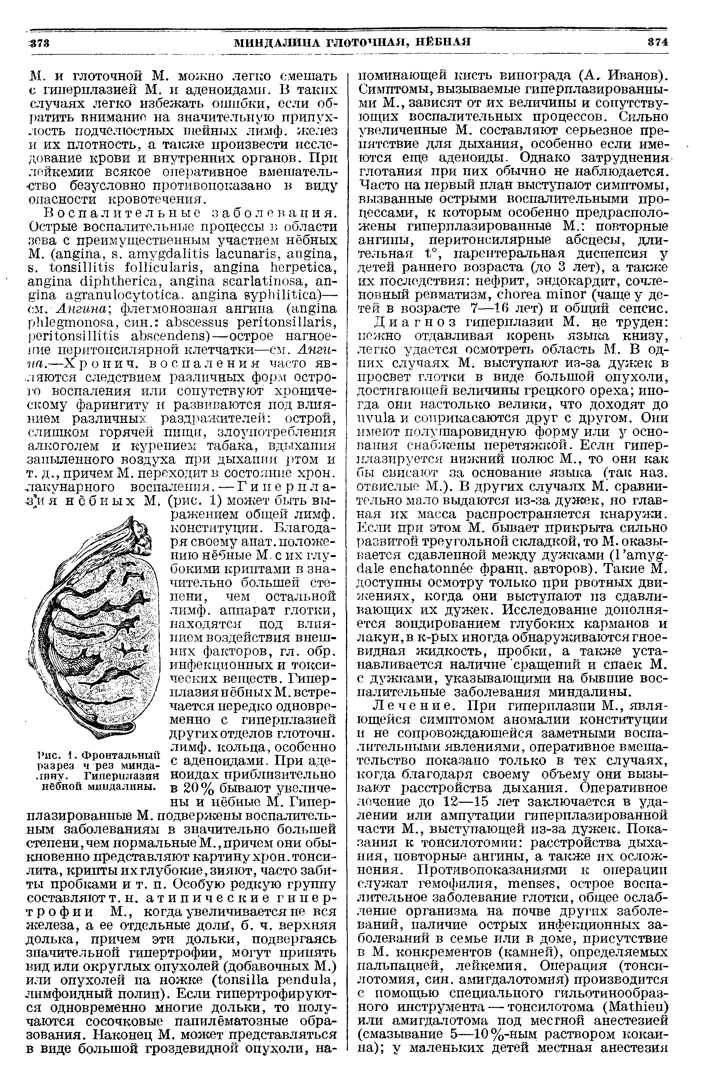 Рис. 1. Фронтальный разрез ч рез миндалину. Гиперплазия нёбной миндалины.