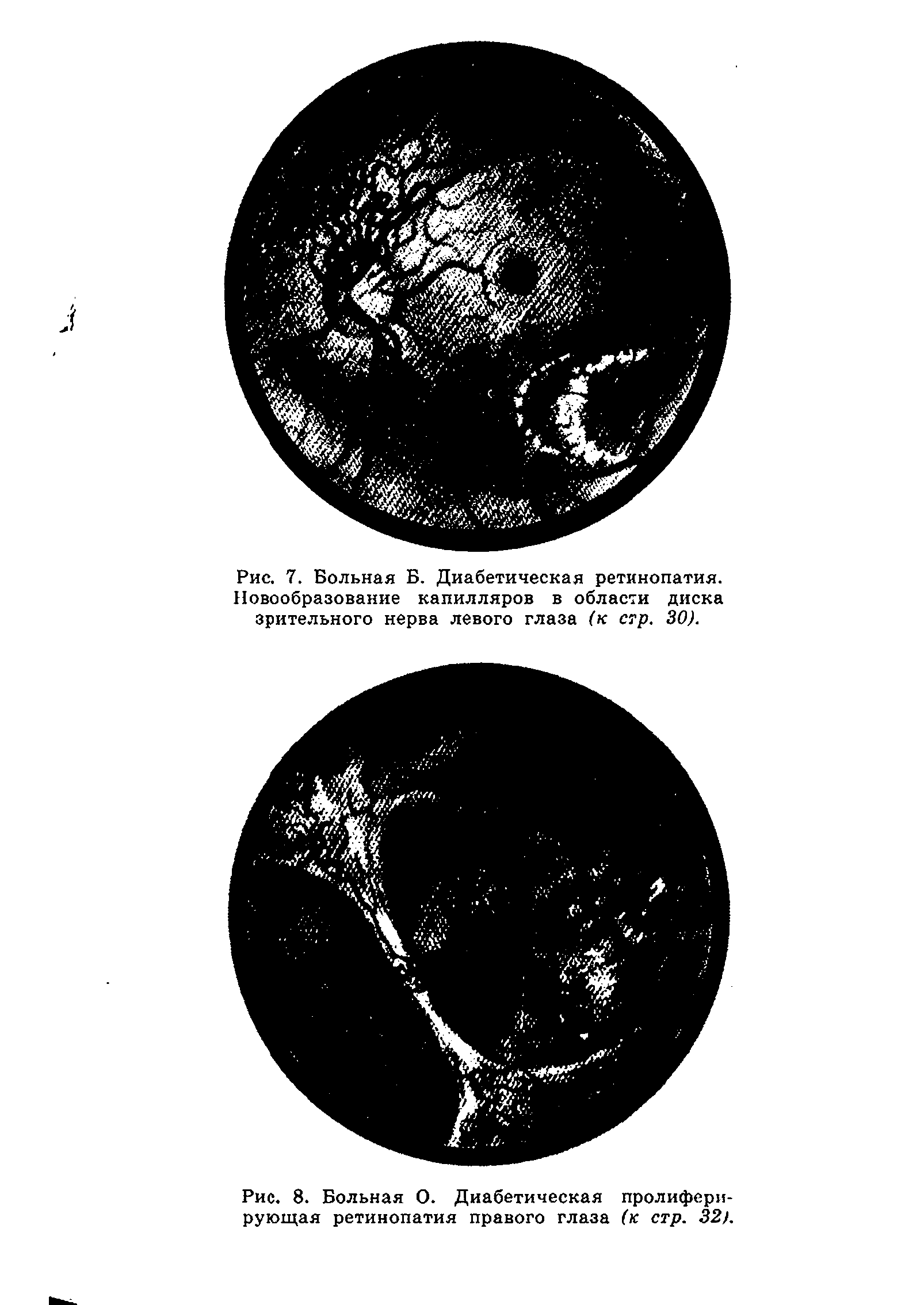 Рис. 8. Больная О. Диабетическая пролиферирующая ретинопатия правого глаза (к стр. 32).
