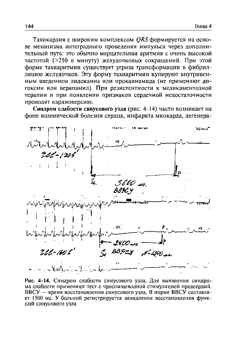 Рис. 4-14. Синдром слабости синусового узла. Для выявления синдрома слабости применяют тест с чреспищеводной стимуляцией предсердий. ВВСУ — время восстановления синусового узла. В норме ВВСУ составляет 1500 мс. У больной регистрируется замедление восстановления функций синусового узла...