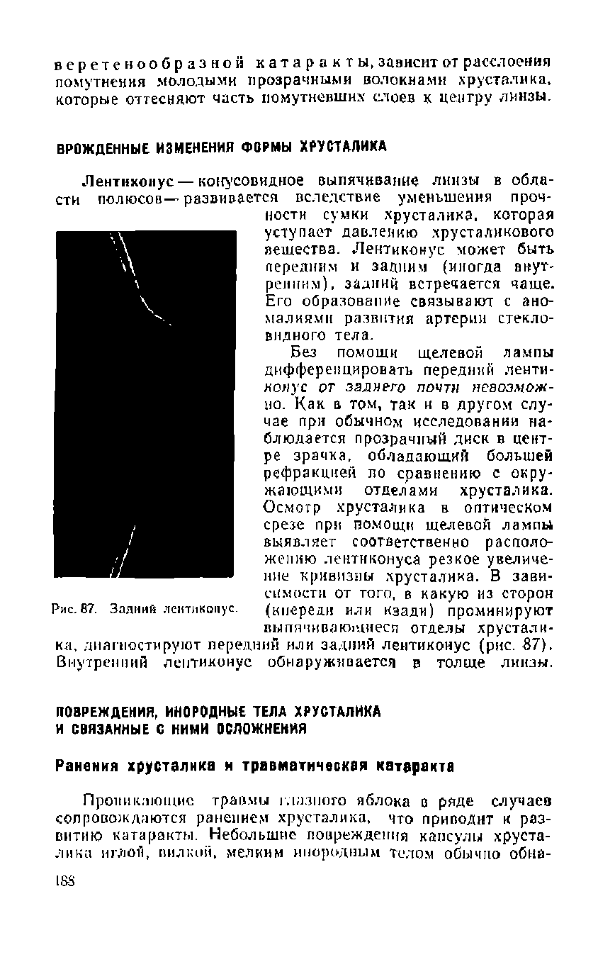 Рис.87. Задний лентиконус. (кпереди или кзади) промнннруют выпячивающиеся отделы хрусталика, диагностируют передний или задний лентиконус (рис. 87). Внутренний лентиконус обнаруживается в толще линзы.