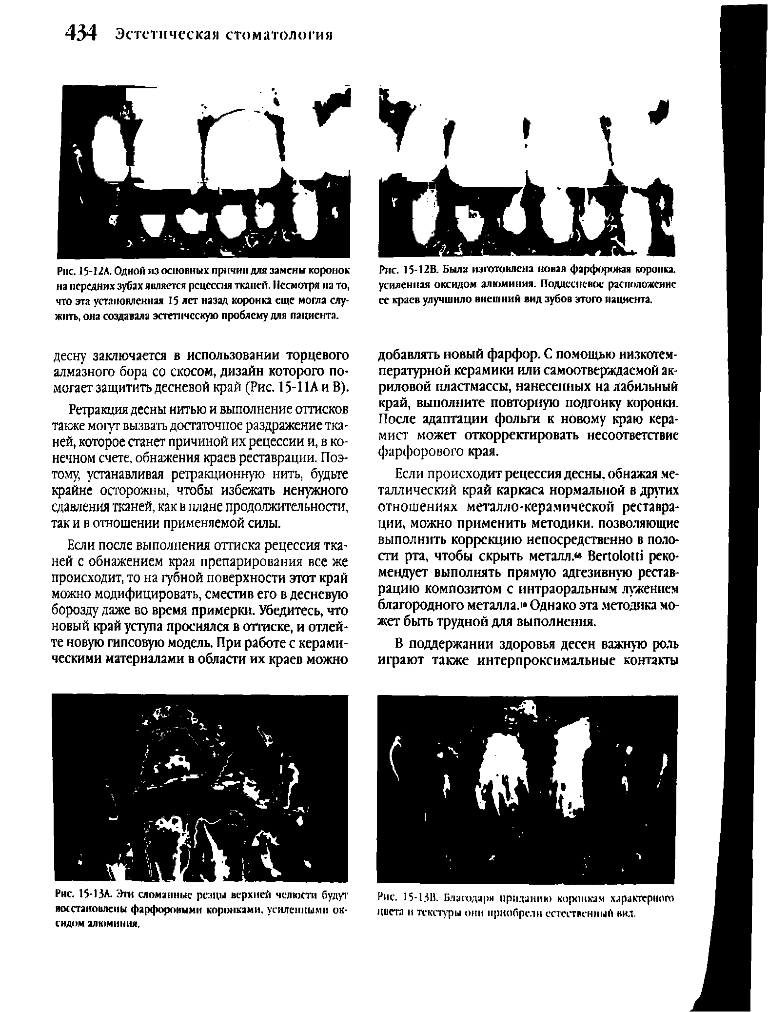 Рис. 15-1 2А. Одной из основных причин для замены коронок на передних зубах является рецессия тканей. 11есмотря на то, что эта установленная 15 лет назад коронка еще могла служить, она создавала эстетическую проблему для пациента.