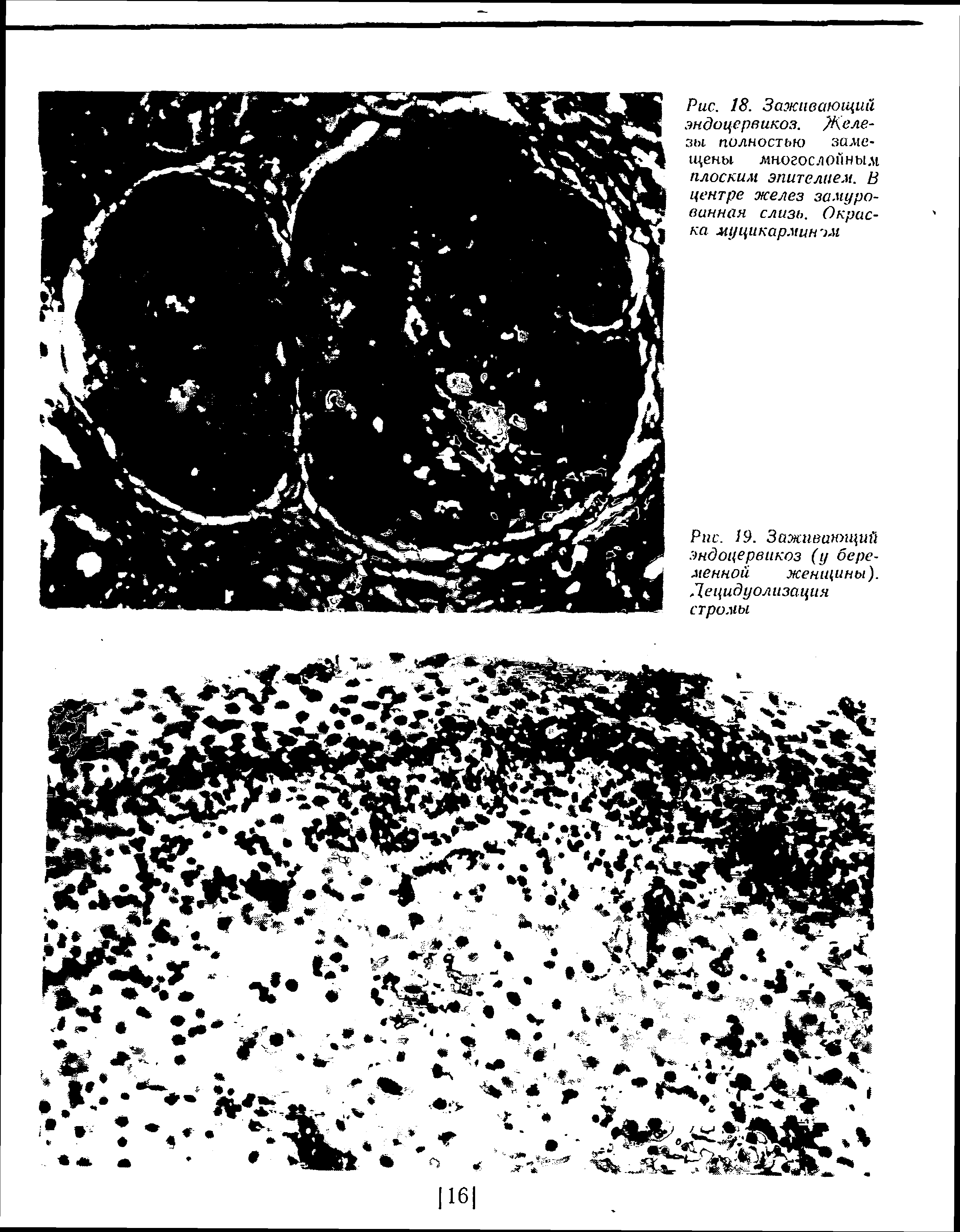 Рис. 9. Заживающий эндоцервикоз (у беременной женщины). Децидуолизация стромы...