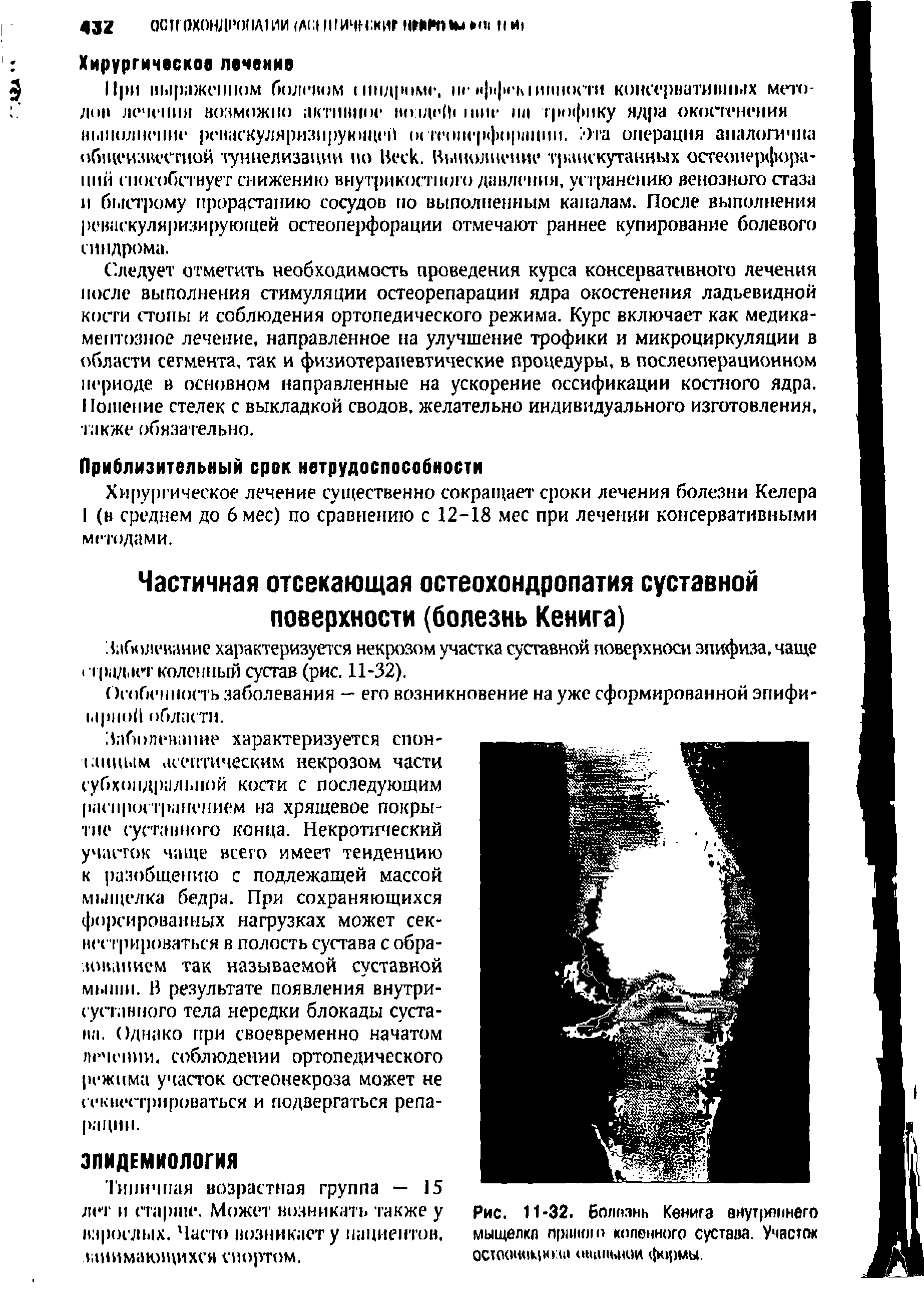 Рис. 11-32. Болезнь Кенига внутреннего мыщелка праною коленного сустава. Участок QCTO<H K < H формы...