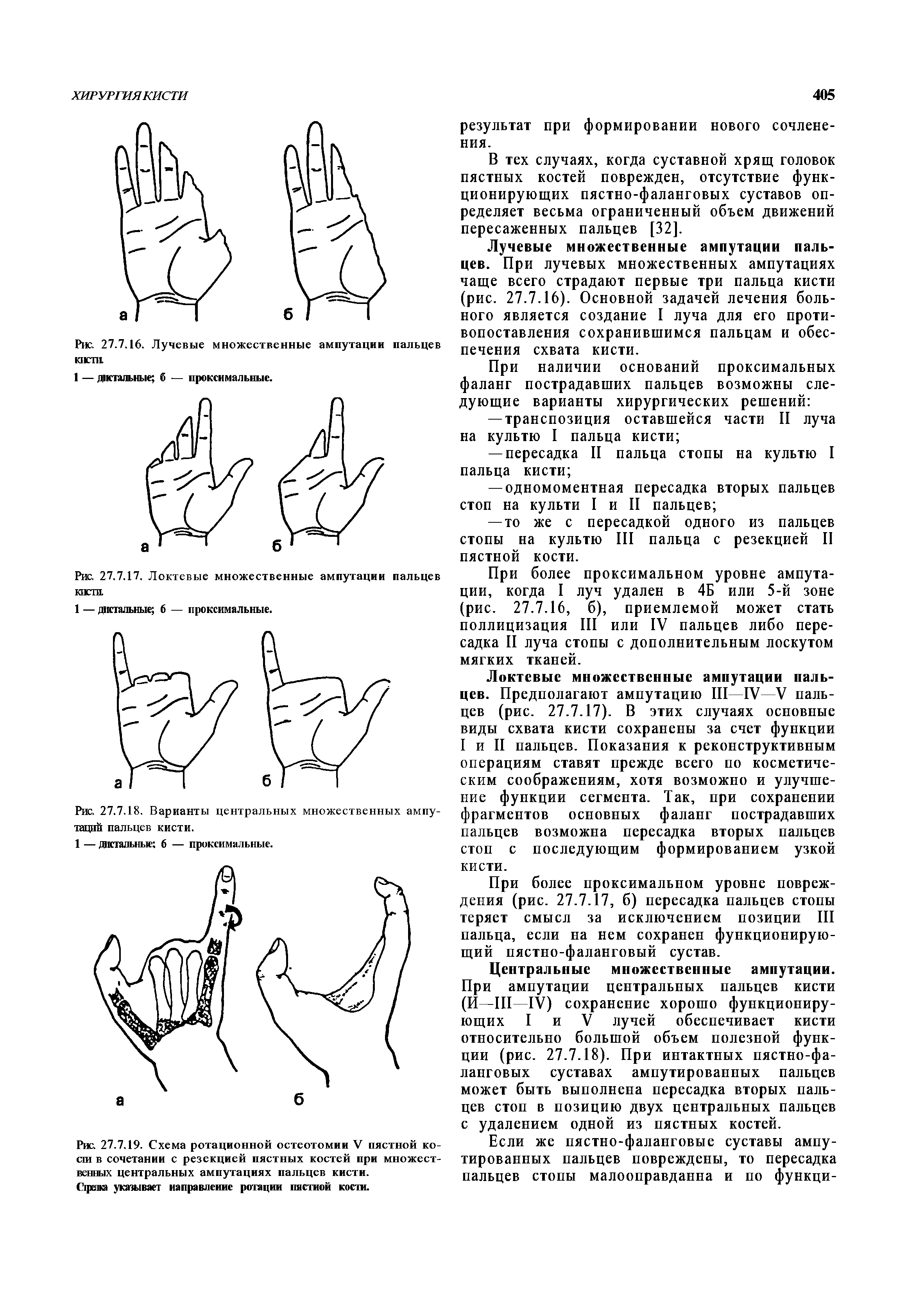 Рис. 27.7.18. Варианты центральных множественных ампутаций пальцев кисти.