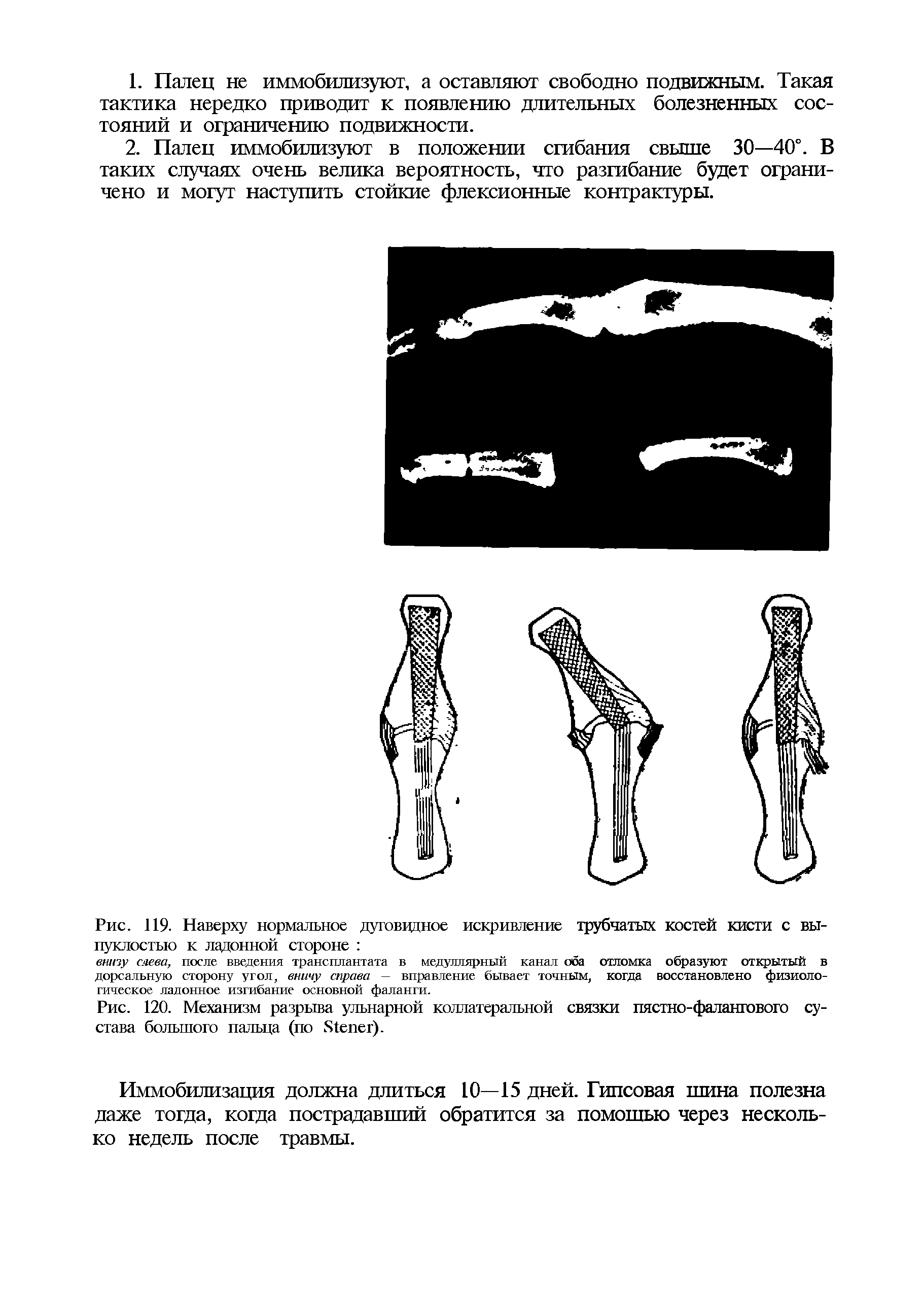 Рис. 120. Механизм разрыва ульнарной коллатеральной связки пястно-фалангового сустава большого пальца (по 81епег).