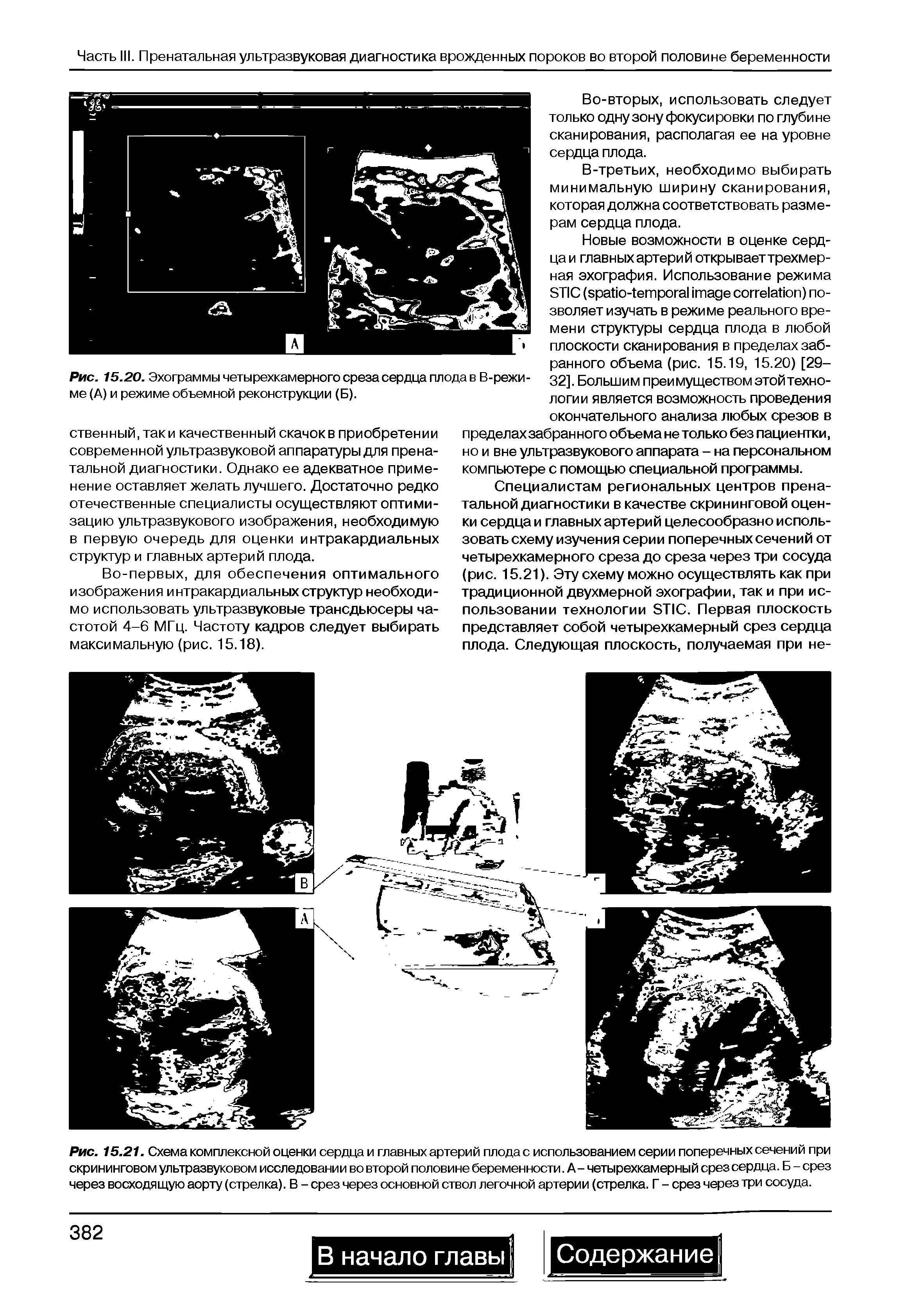 Рис. 15.21. Схема комплексной оценки сердца и главных артерий плода с использованием серии поперечных сечений при скрининговом ультразвуковом исследовании во второй половине беременности. А- четырехкамерный срез сердца. Б - срез через восходящую аорту (стрелка). В - срез через основной ствол легочной артерии (стрелка. Г - срез через три сосуда.