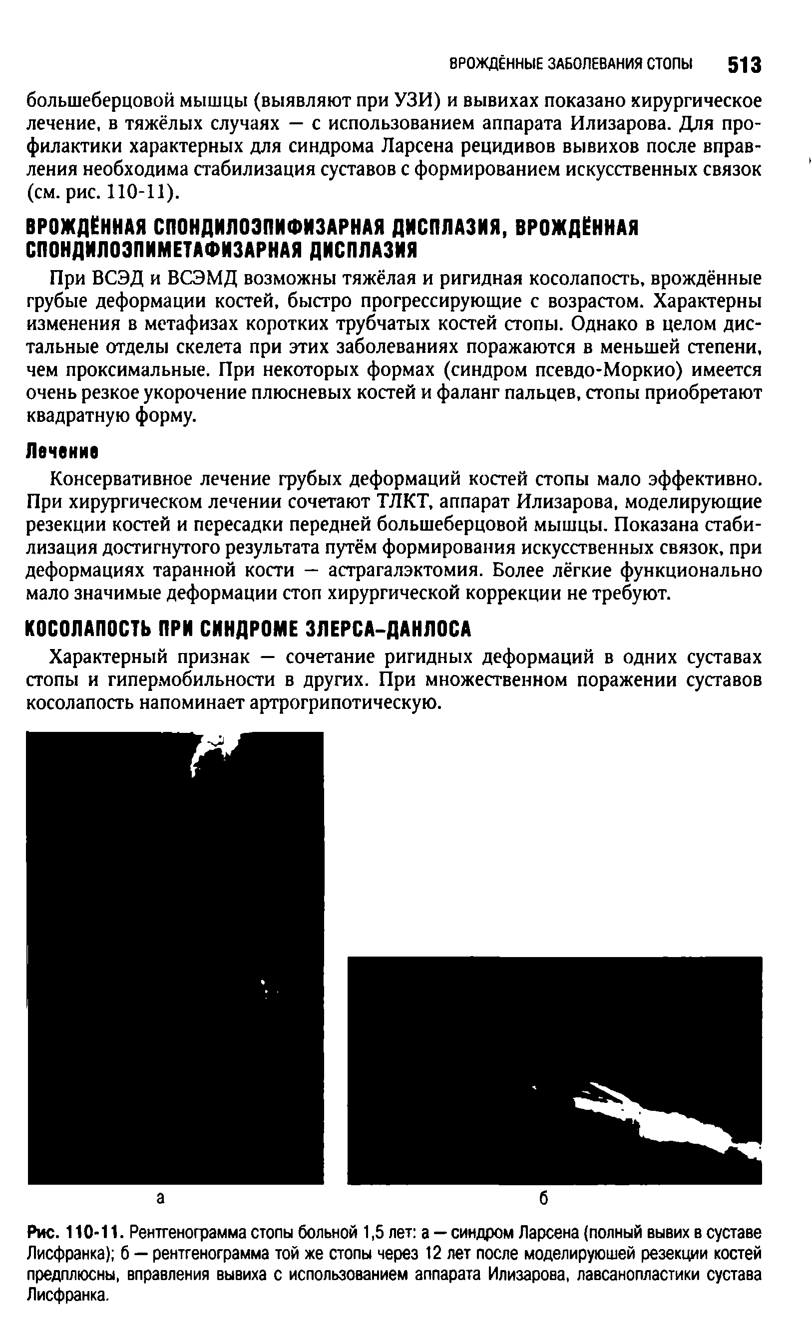 Рис. 110-11. Рентгенограмма стопы больной 1,5 лет а —синдром Ларсена (полный вывих в суставе Лисфранка) б — рентгенограмма той же стопы через 12 лет после моделирующей резекции костей предплюсны, вправления вывиха с использованием аппарата Илизарова, лавсанопластики сустава Лисфранка.