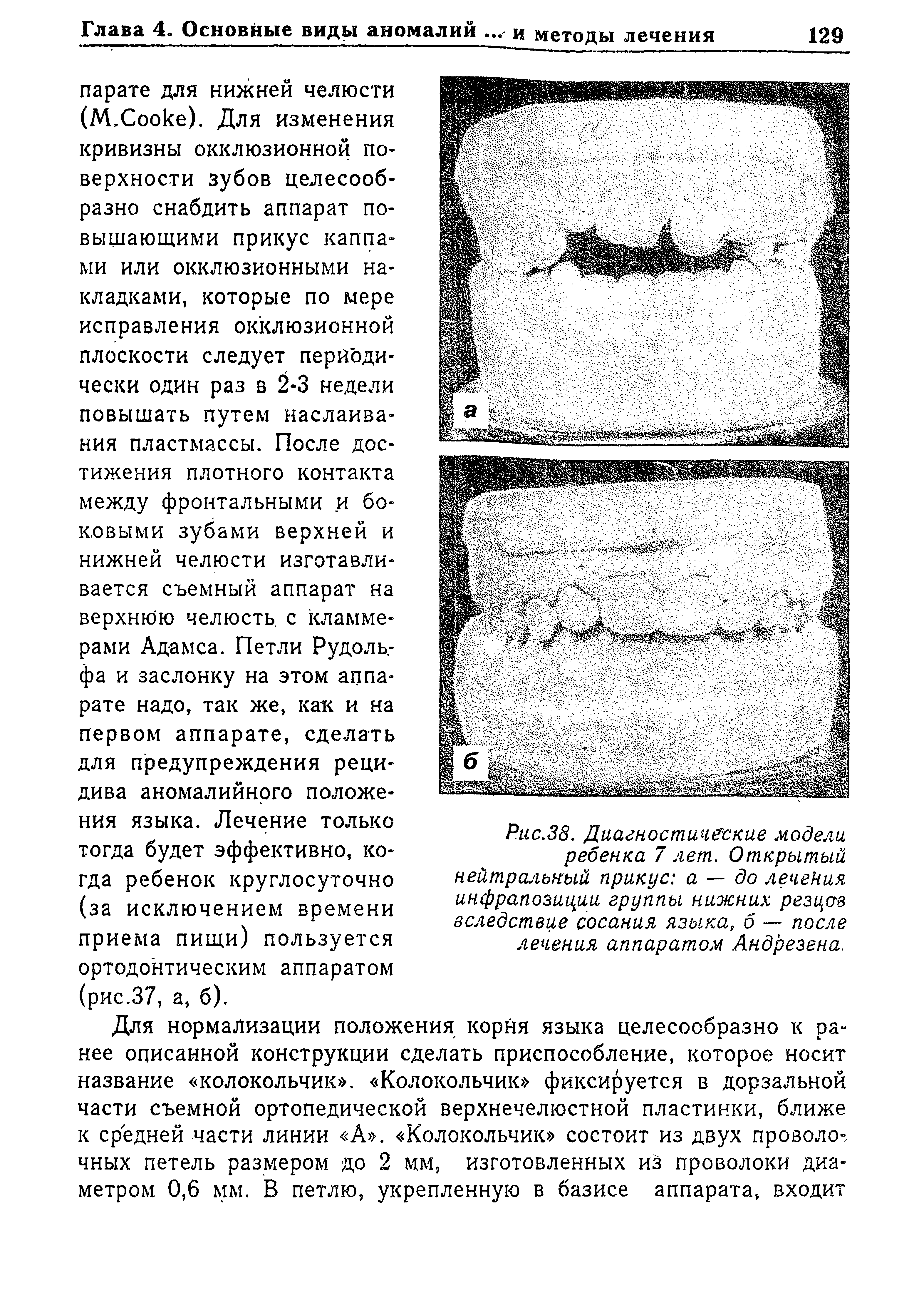 Рис.38. Диагностические модели ребенка 7 лет. Открытый нейтральный прикус а — до лечения инфрапозиции группы нижних резцов вследствие сосания языка, б — после лечения аппаратом Андрезена.