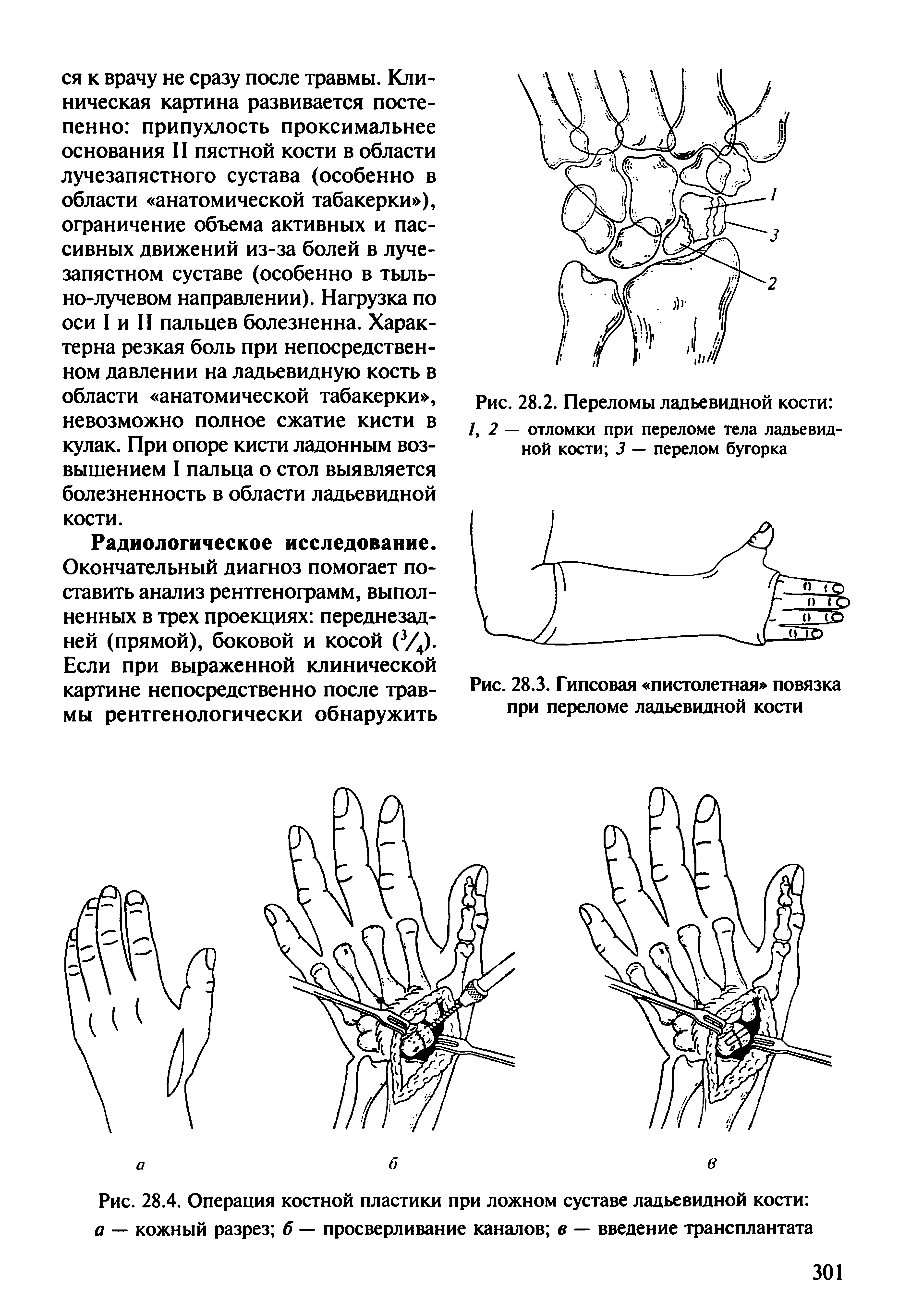Рис. 28.4. Операция костной пластики при ложном суставе ладьевидной кости а — кожный разрез б — просверливание каналов в — введение трансплантата...