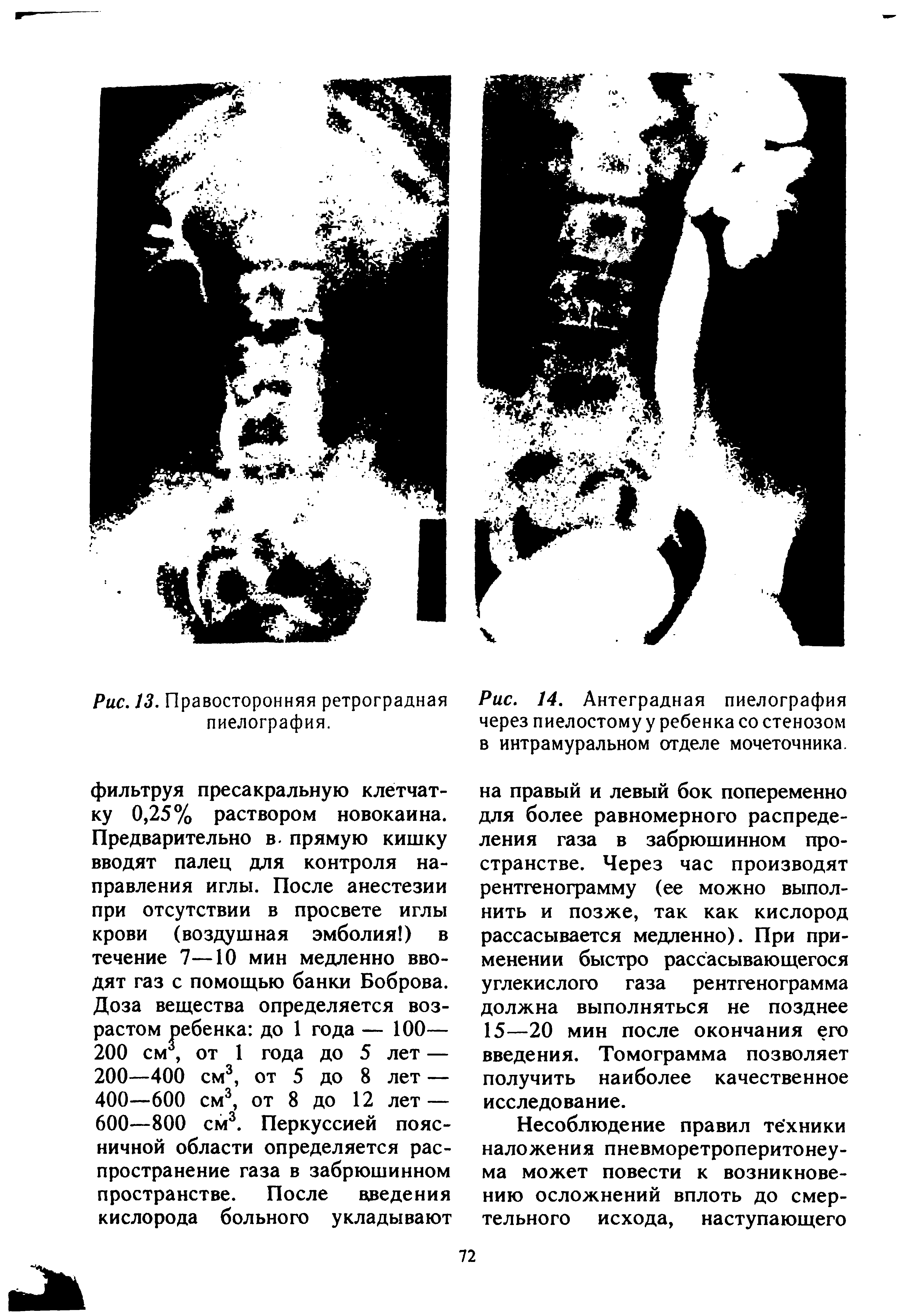 Рис. 14. Антеградная пиелография через пиелостому у ребенка со стенозом в интрамуральном отделе мочеточника.