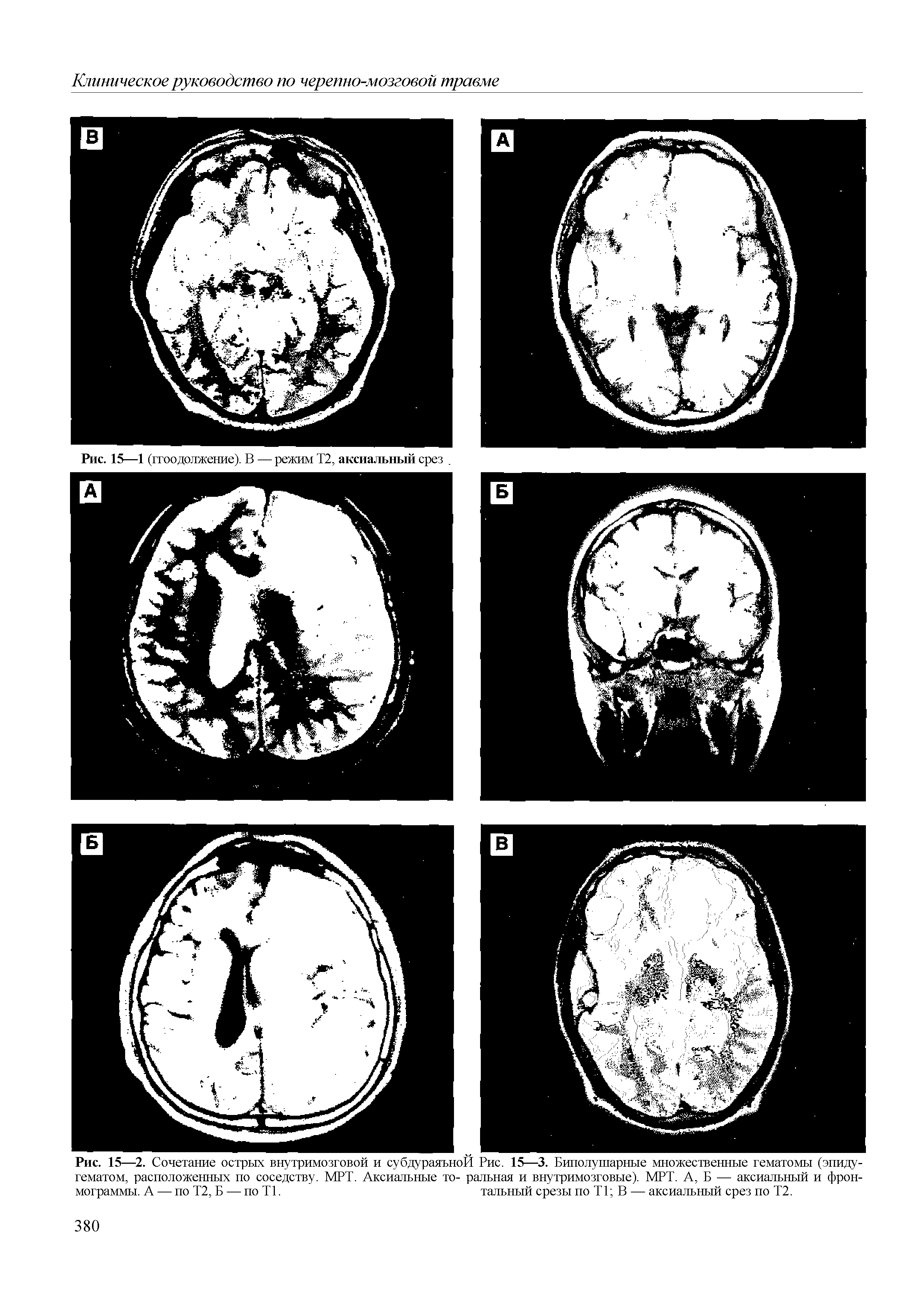 Рис. 15—2. Сочетание острых внутримозговой и субдураяъноЙ Рис. 15—3. Биполушарные множественные гематомы (эпиду-гематом, расположенных по соседству. МРТ. Аксиальные то- ральная и внутримозговые). МРТ. А, Б — аксиальный и фрон-мограммы. А — по Т2, Б — по Т1. тальный срезы по Т1 В — аксиальный срез по Т2.