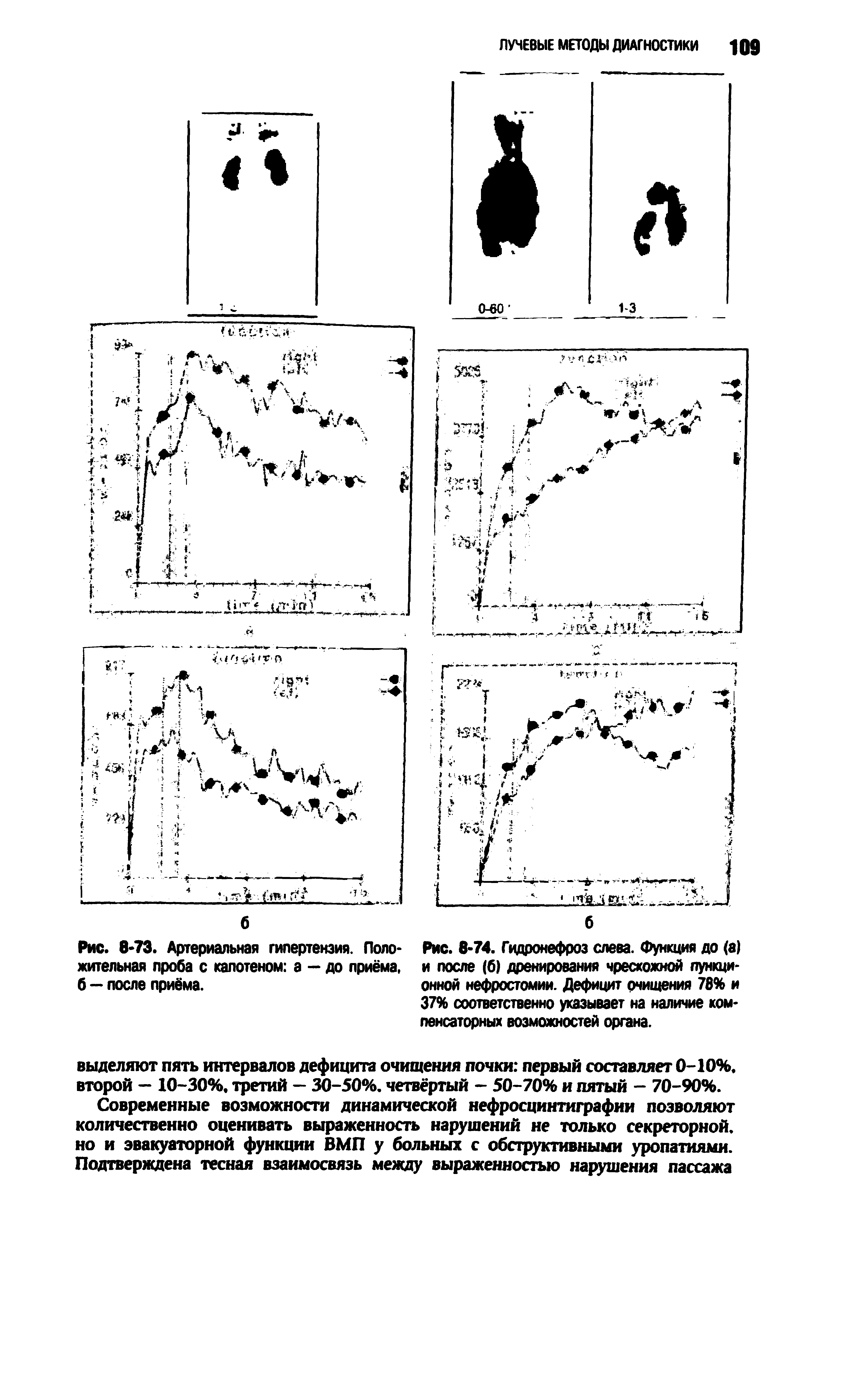 Рис. 8-74. Гидронефроз слева. Функция до (а) и после (б) дренирований чрескожной пункционной нефростомии. Дефицит очищения 78% и 37% соответственно указывает на наличие компенсаторных возможностей органа.