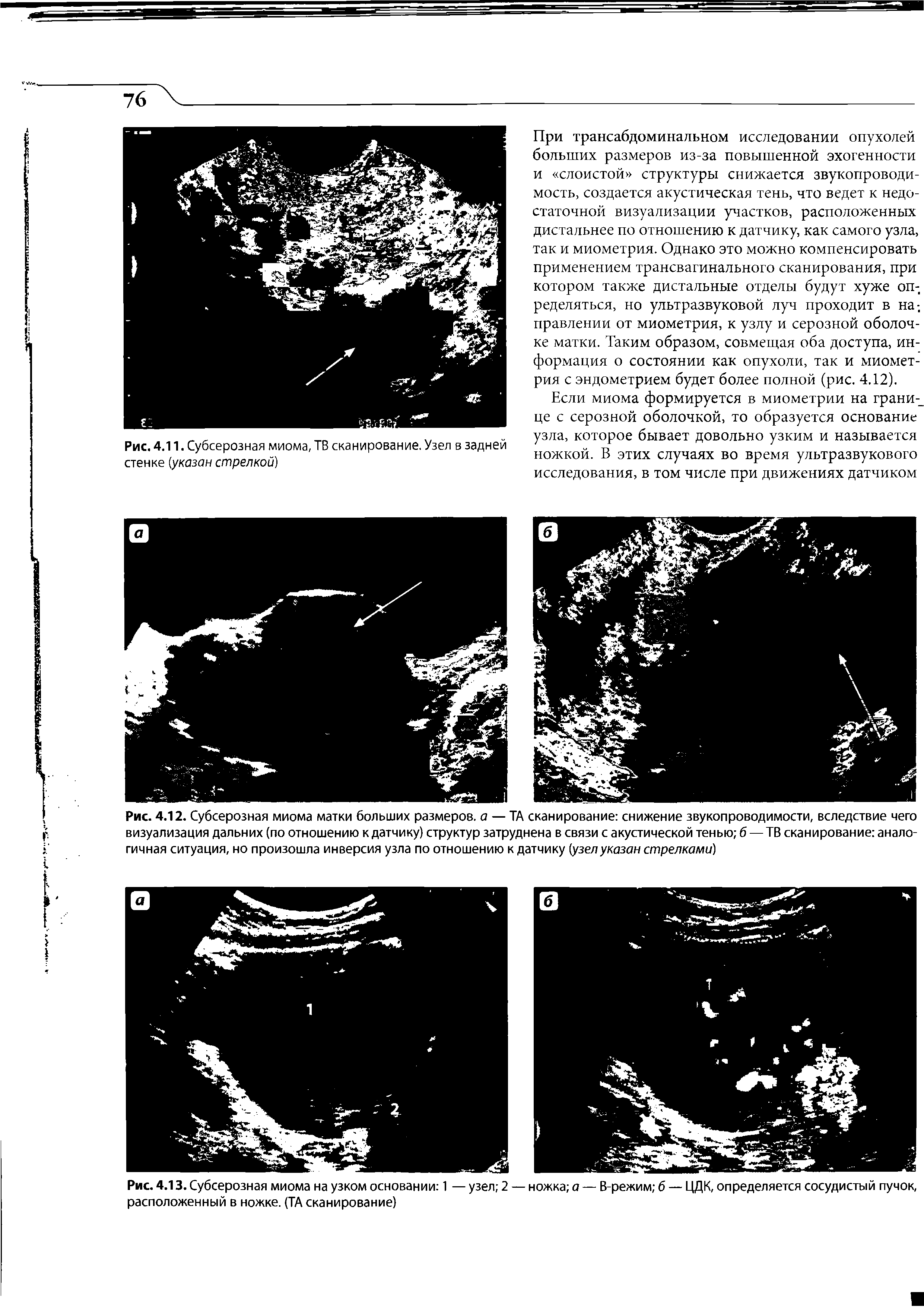Рис. 4.13. Субсерозная миома на узком основании 1 — узел 2 — ножка а — В-режим 6 — ЦДК, определяется сосудистый пучок, расположенный в ножке. (ТА сканирование)...
