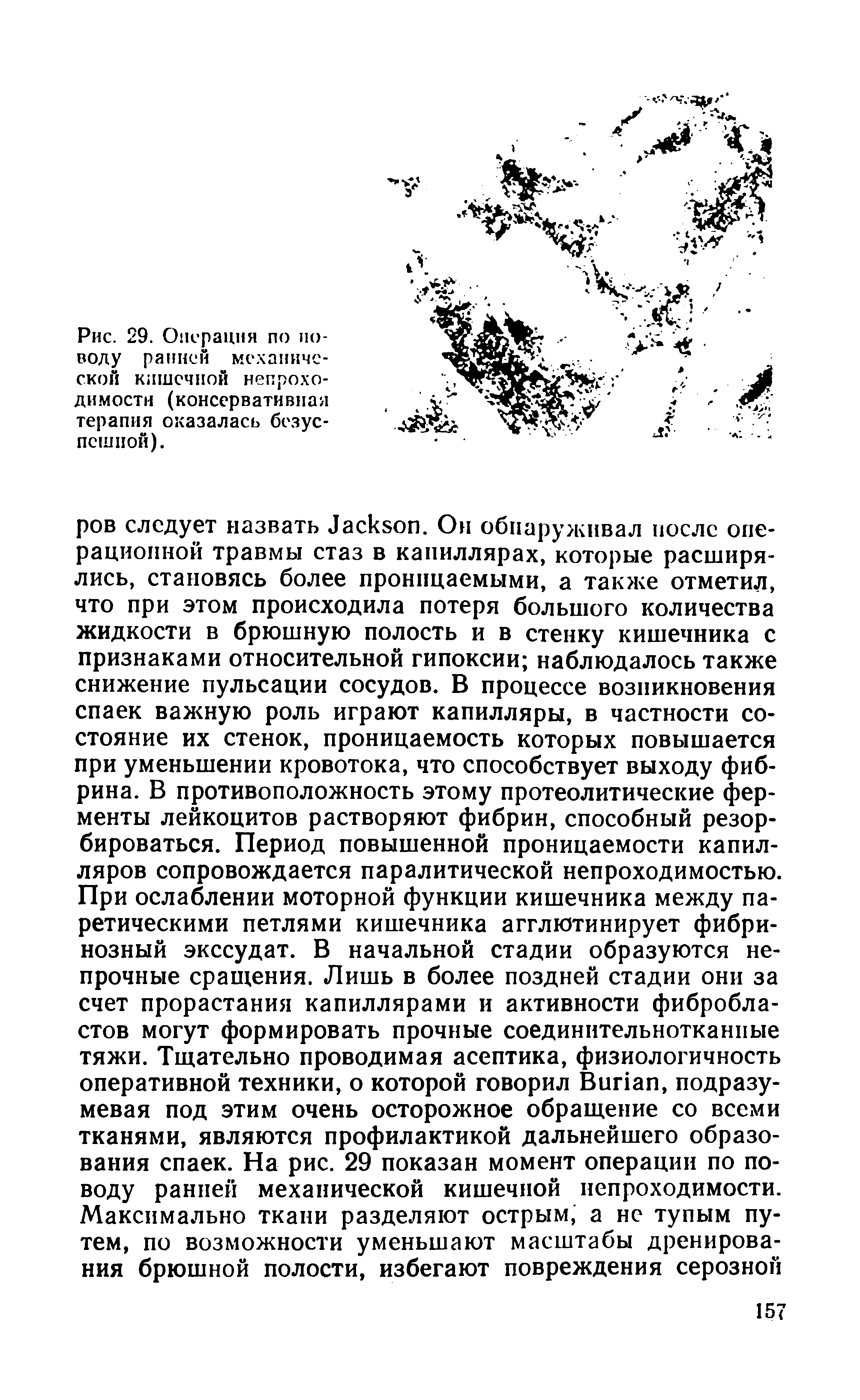 Рис. 29. Операция по поводу ранней механической кишечной непроходимости (консервативная терапия оказалась безуспешной).