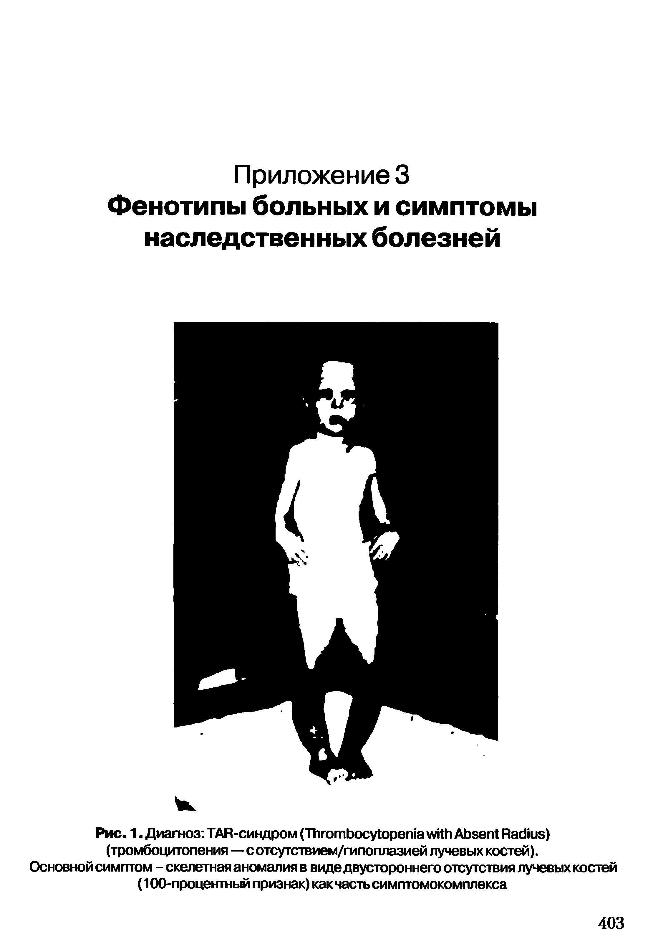 Рис. 1. Диагноз TAR-синдром (T A R ) (тромбоцитопения—с отсутствием/гипоплазией лучевых костей).