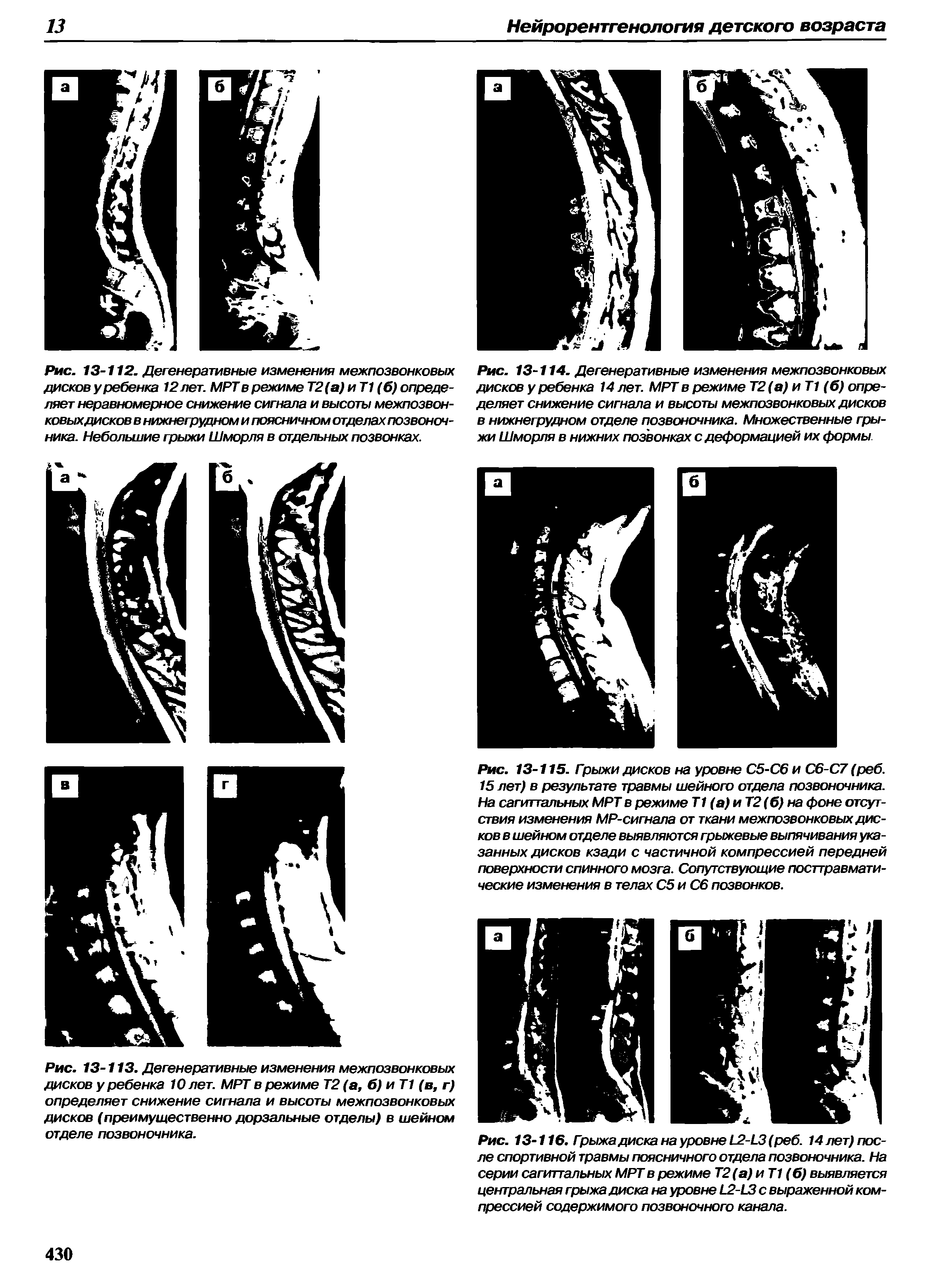 Рис. 13-114. Дегенеративные изменения межпозвонковых дисков у ребенка 14 лет. МРТ в режиме Т2(а) иТ1 (б) определяет снижение сигнала и высоты межпозвонковых дисков в нижнегрудном отделе позвоночника. Множественные грыжи Шморля в нижних позвонках с деформацией их формы.