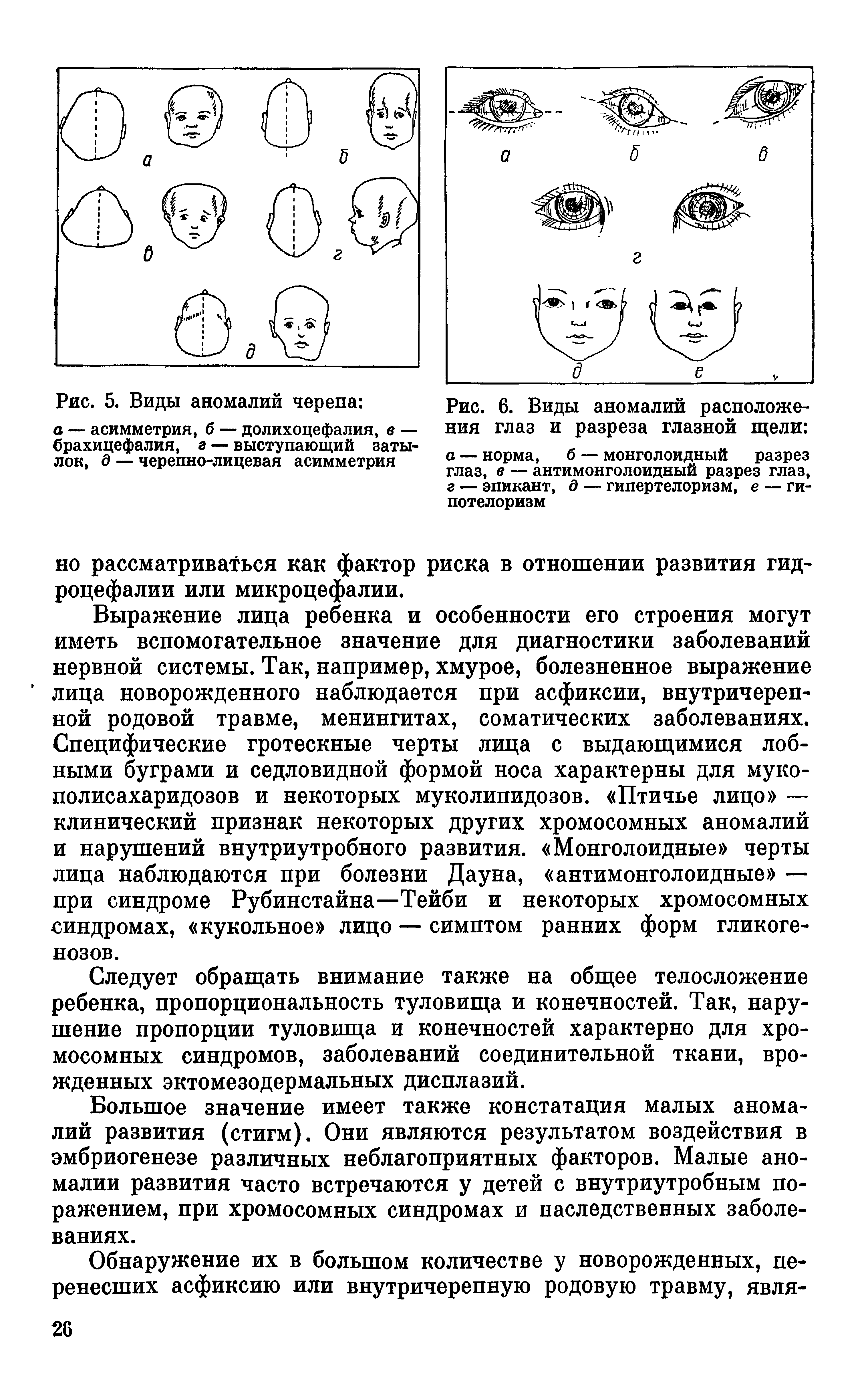 Рис. 6. Виды аномалий расположения глаз и разреза глазной щели а — норма, б — монголоидный разрез глаз, в — антимонголоидный разрез глаз, г — эпикант, д — гипертелоризм, е — ги-потелоризм...