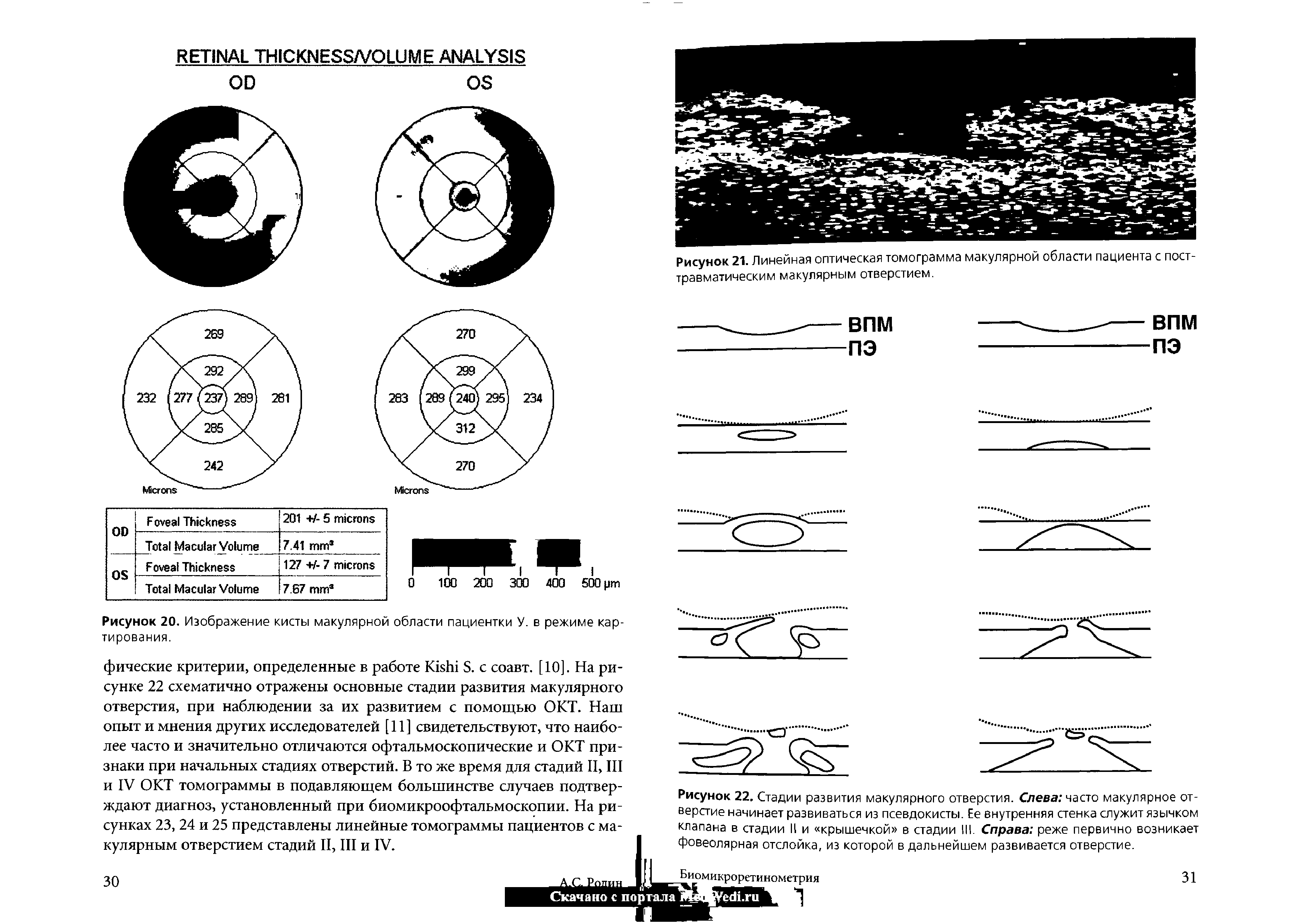 Рисунок 21. Линейная оптическая томограмма макулярной области пациента с посттравматическим макулярным отверстием.