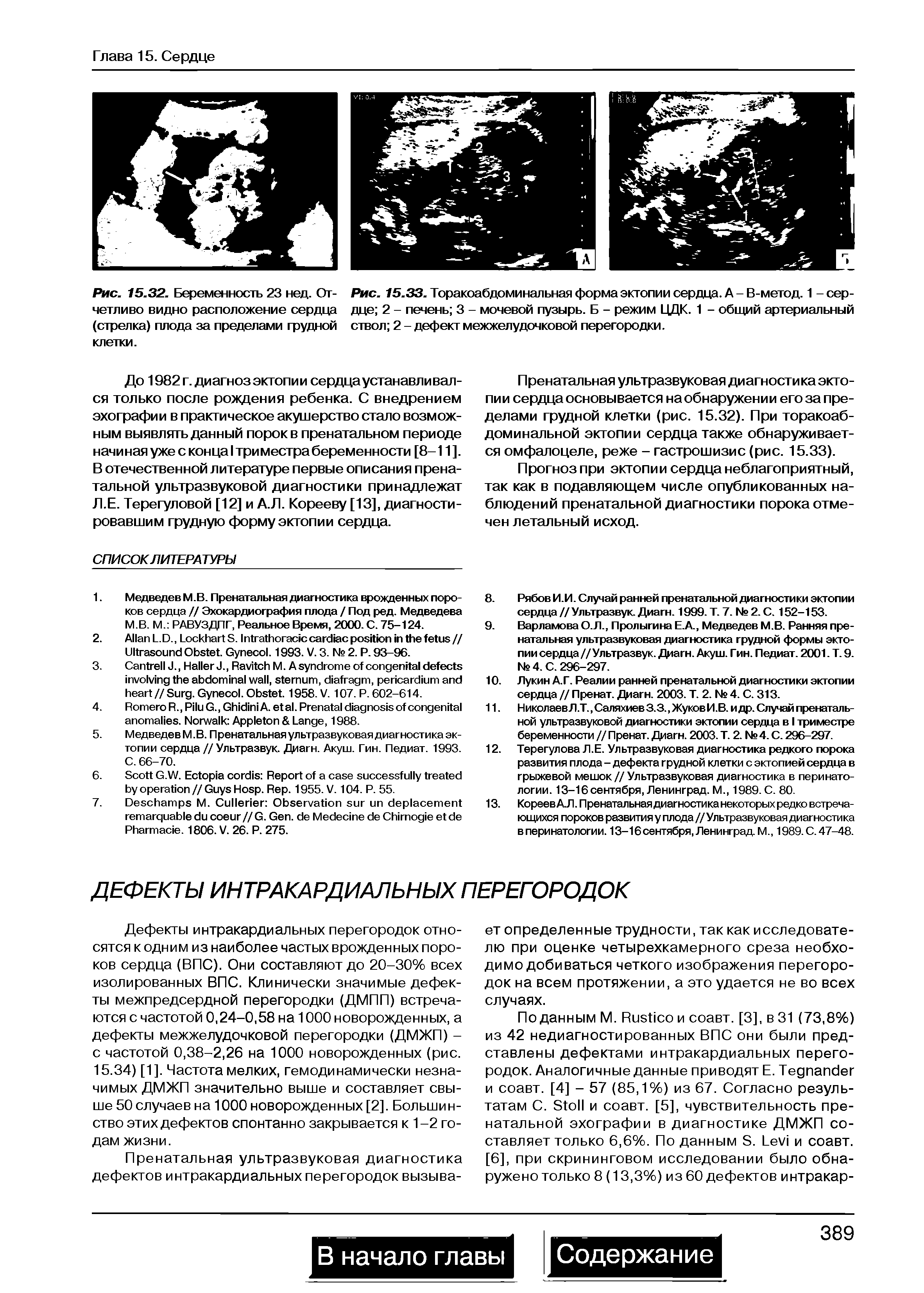 Рис. 15.33. Торакоабдоминальная форма эктопии сердца. А - В-метод. 1 - сердце 2 - печень 3 - мочевой пузырь. Б - режим ЦДК. 1 - общий артериальный ствол 2 - дефект межжелудочковой перегородки.