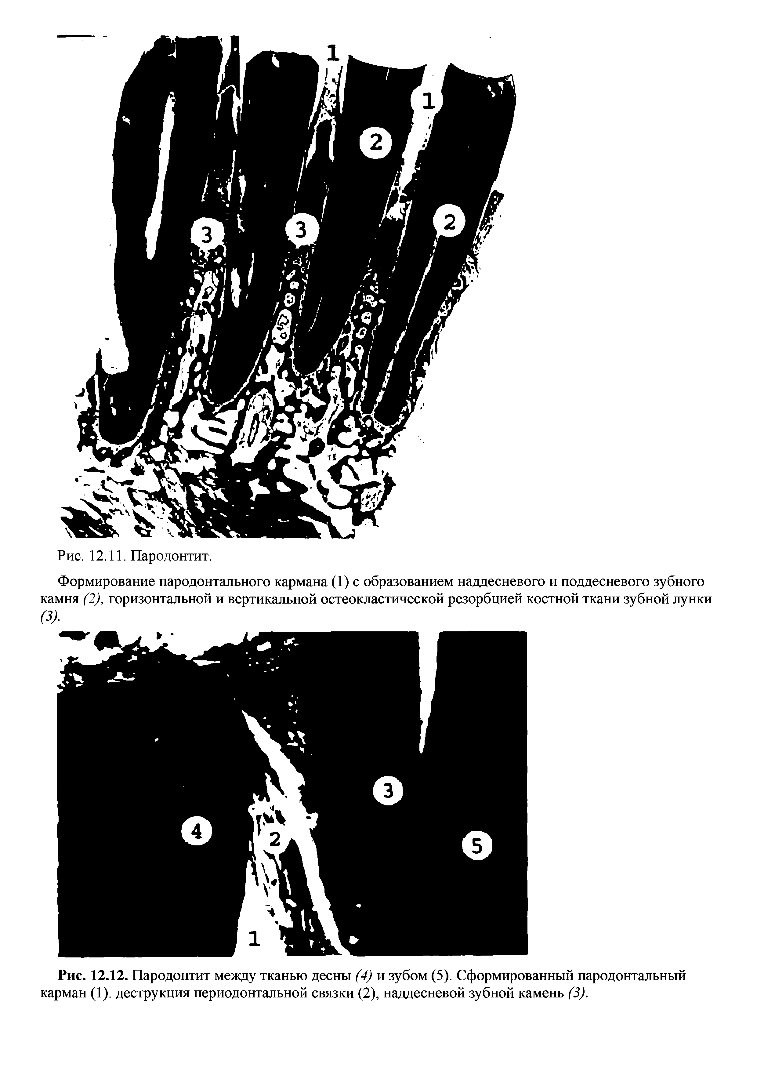 Рис. 12.12. Пародонтит между тканью десны (4) и зубом (5). Сформированный пародонтальный карман (1). деструкция периодонтальной связки (2), наддесневой зубной камень (3).