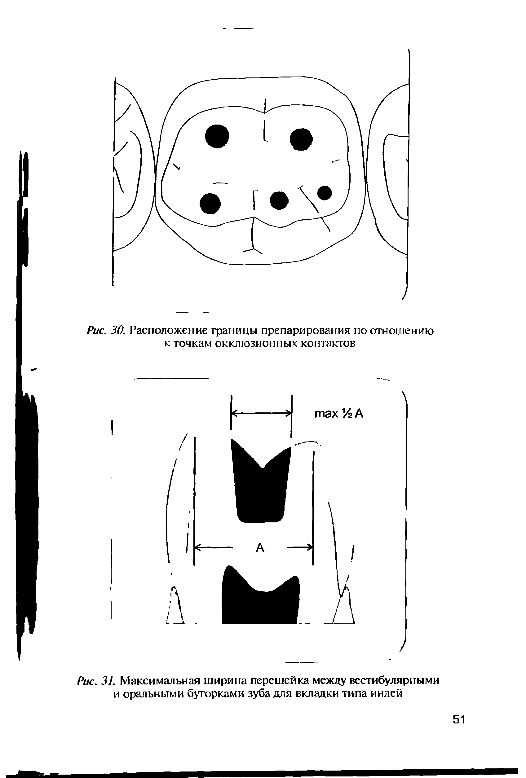 Рис. 31. Максимальная ширина перешейка между вестибулярными и оральными бугорками зуба для вкладки типа инлей...
