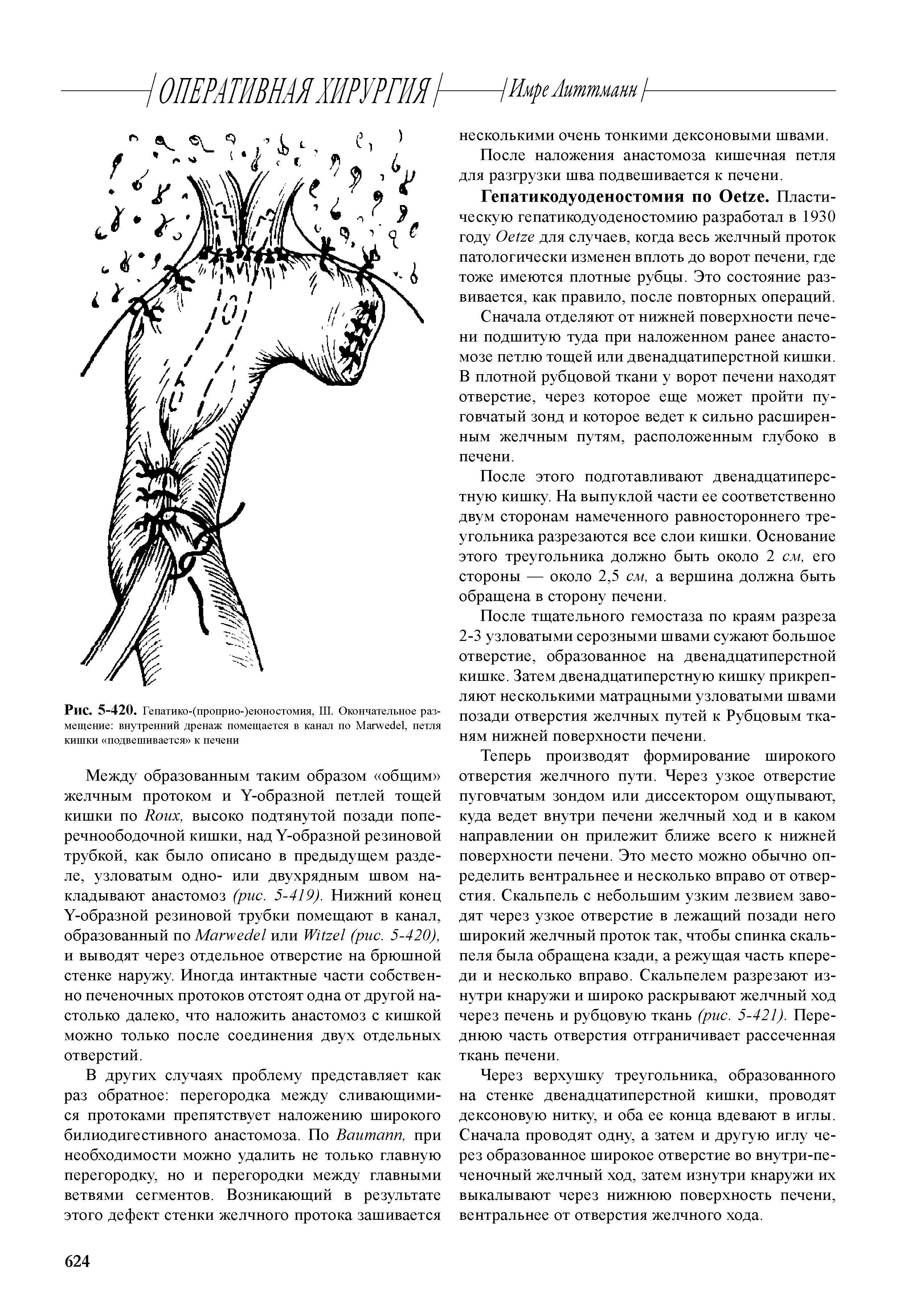 Рис. 5-420. Гепатико-(проприо-)еюностомия, III. Окончательное размещение внутренний дренаж помещается в канал по M , петля кишки подвешивается к печени...