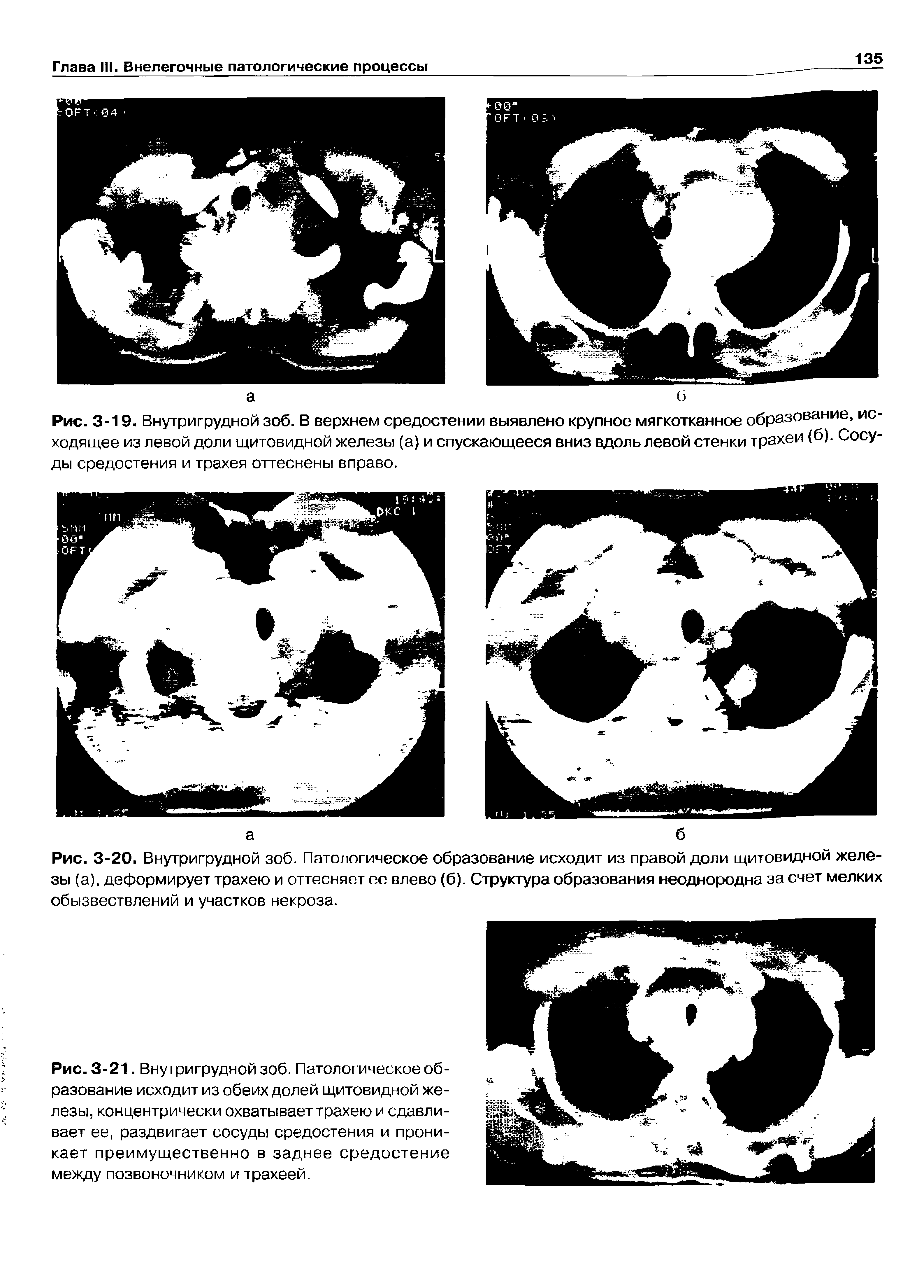 Рис. 3-19. Внутригрудной зоб. В верхнем средостении выявлено крупное мягкотканное образование, ис ходящее из левой доли щитовидной железы (а) и спускающееся вниз вдоль левой стенки трахеи (б). Сосу...