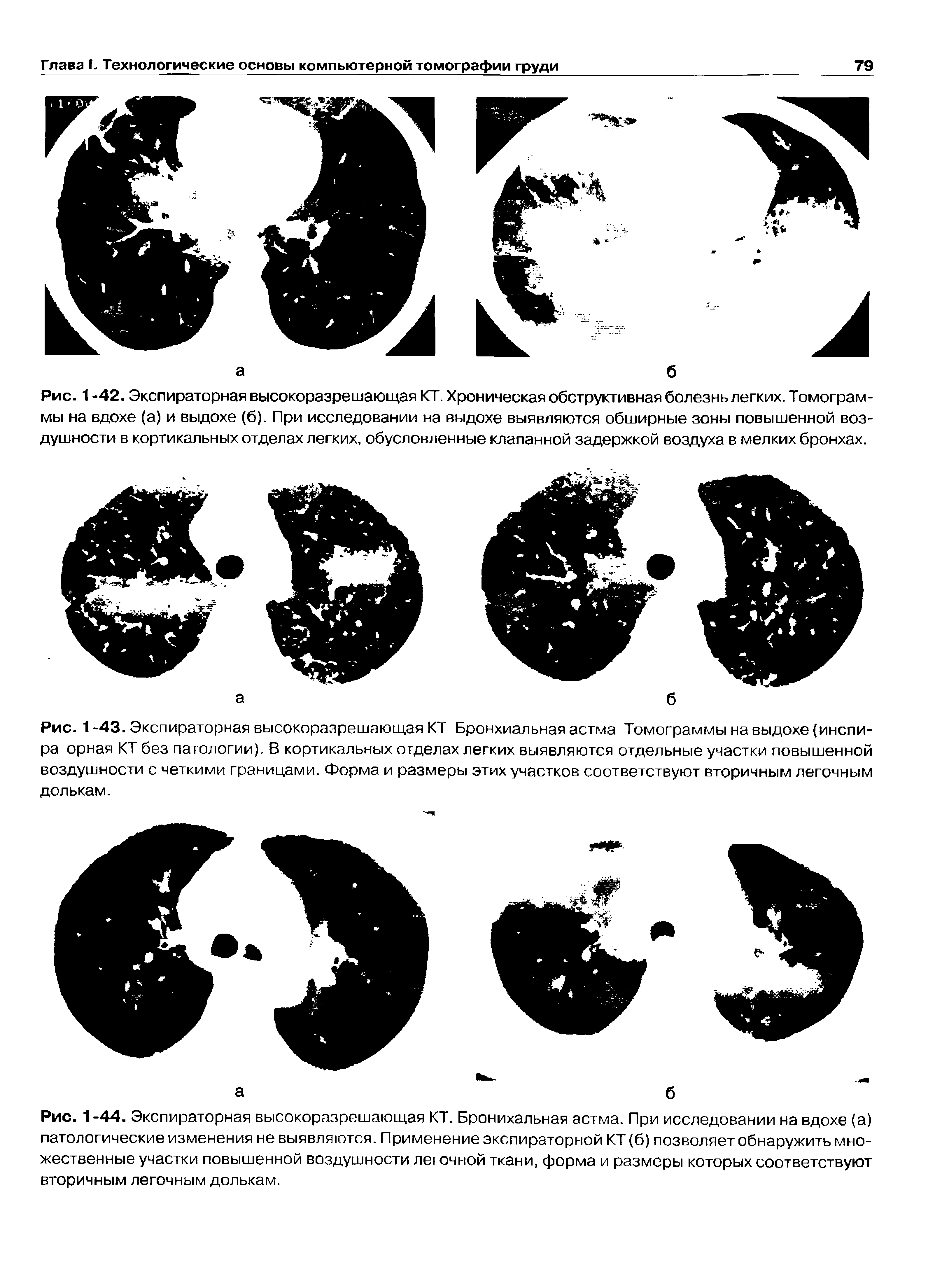 Рис. 1-44. Экспираторная высокоразрешающая КТ. Бронихальная астма. При исследовании на вдохе (а) патологические изменения не выявляются. Применение экспираторной КТ (б) позволяет обнаружить множественные участки повышенной воздушности легочной ткани, форма и размеры которых соответствуют вторичным легочным долькам.