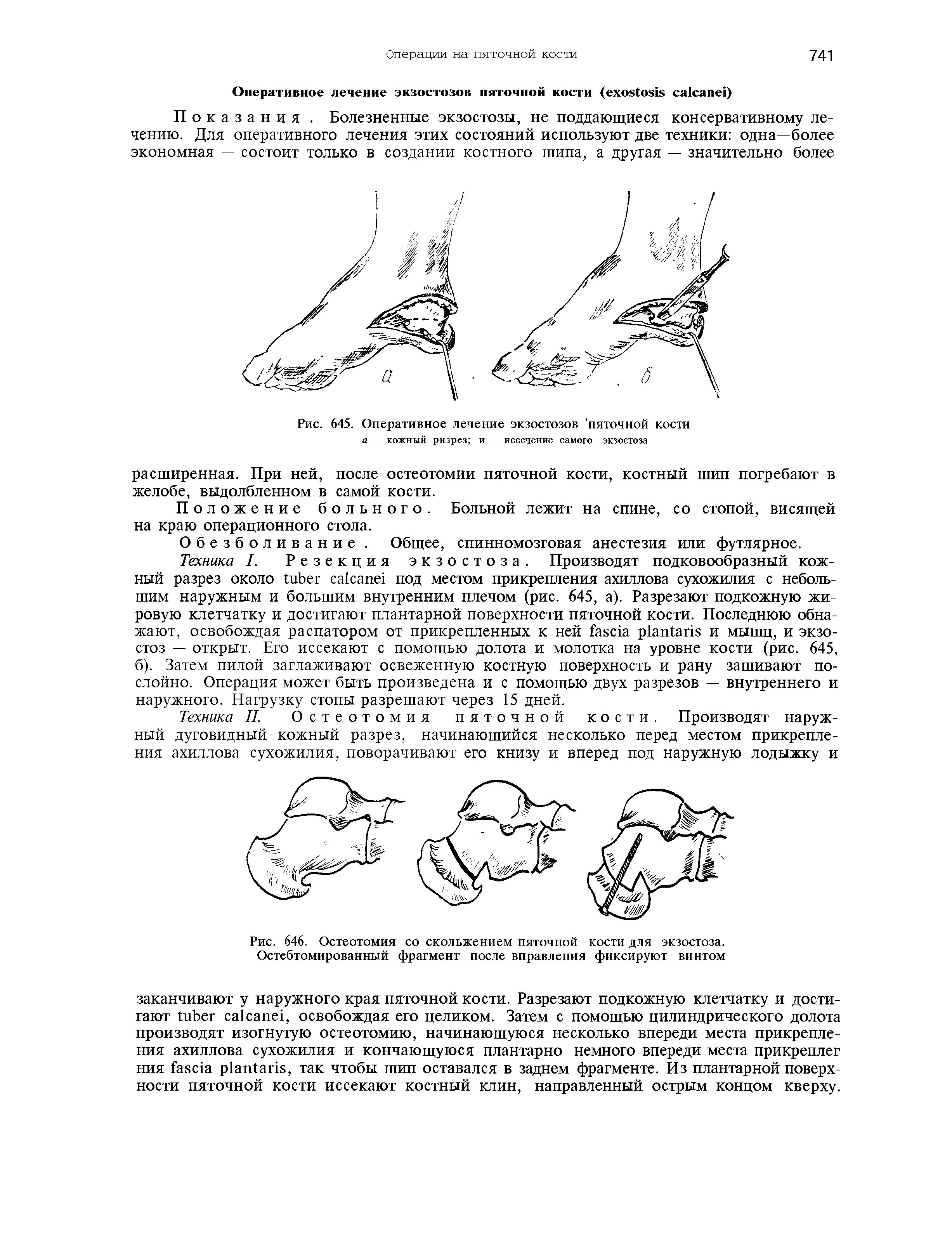 Рис. 646. Остеотомия со скольжением пяточной кости для экзостоза. Остебтомированный фрагмент после вправления фиксируют винтом...