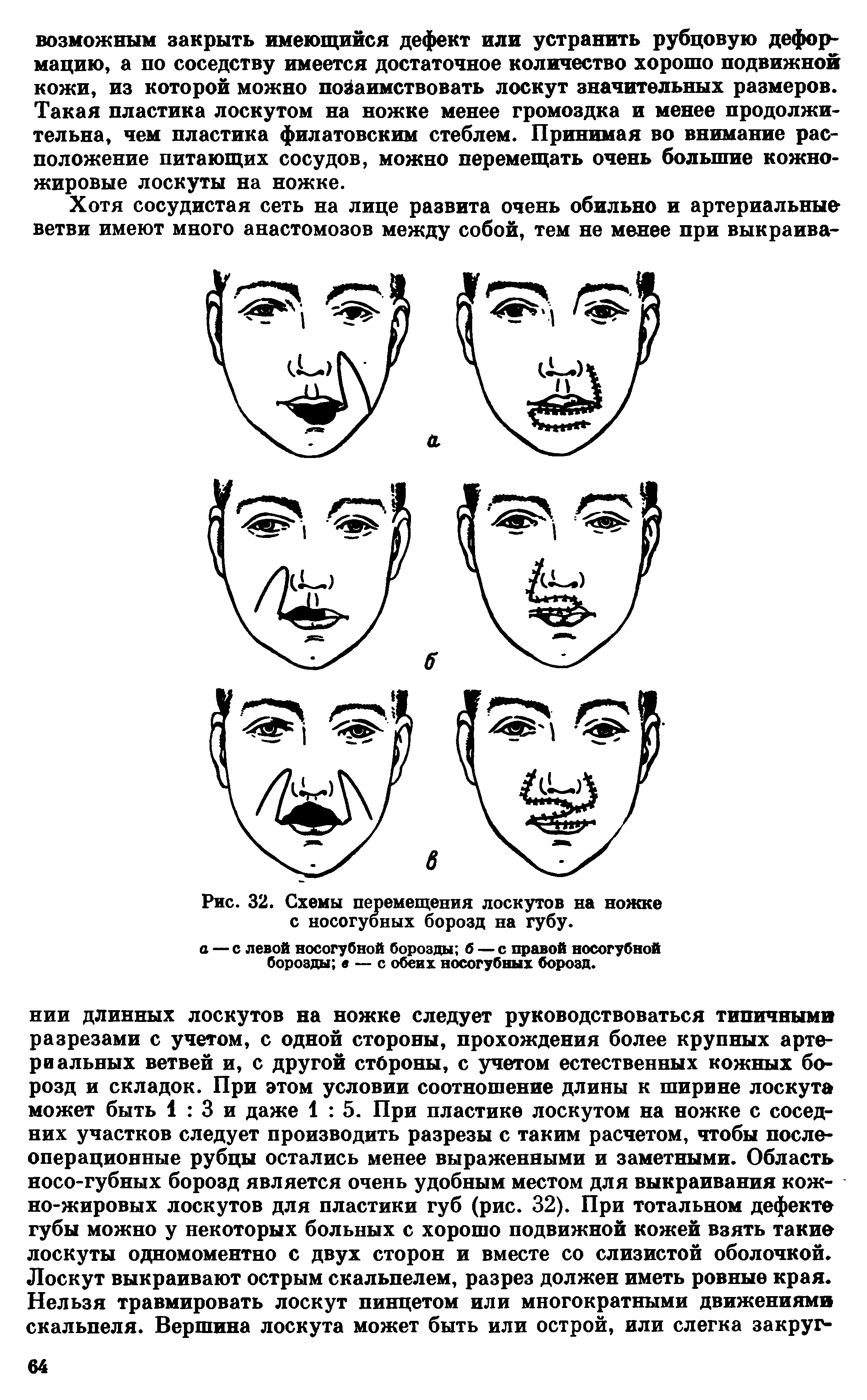 Рис. 32. Схемы перемещения лоскутов на ножке с носогубных борозд на губу.